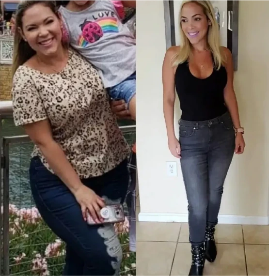Female patient in a leopard print top before bariatric surgery and in a black top and jeans after