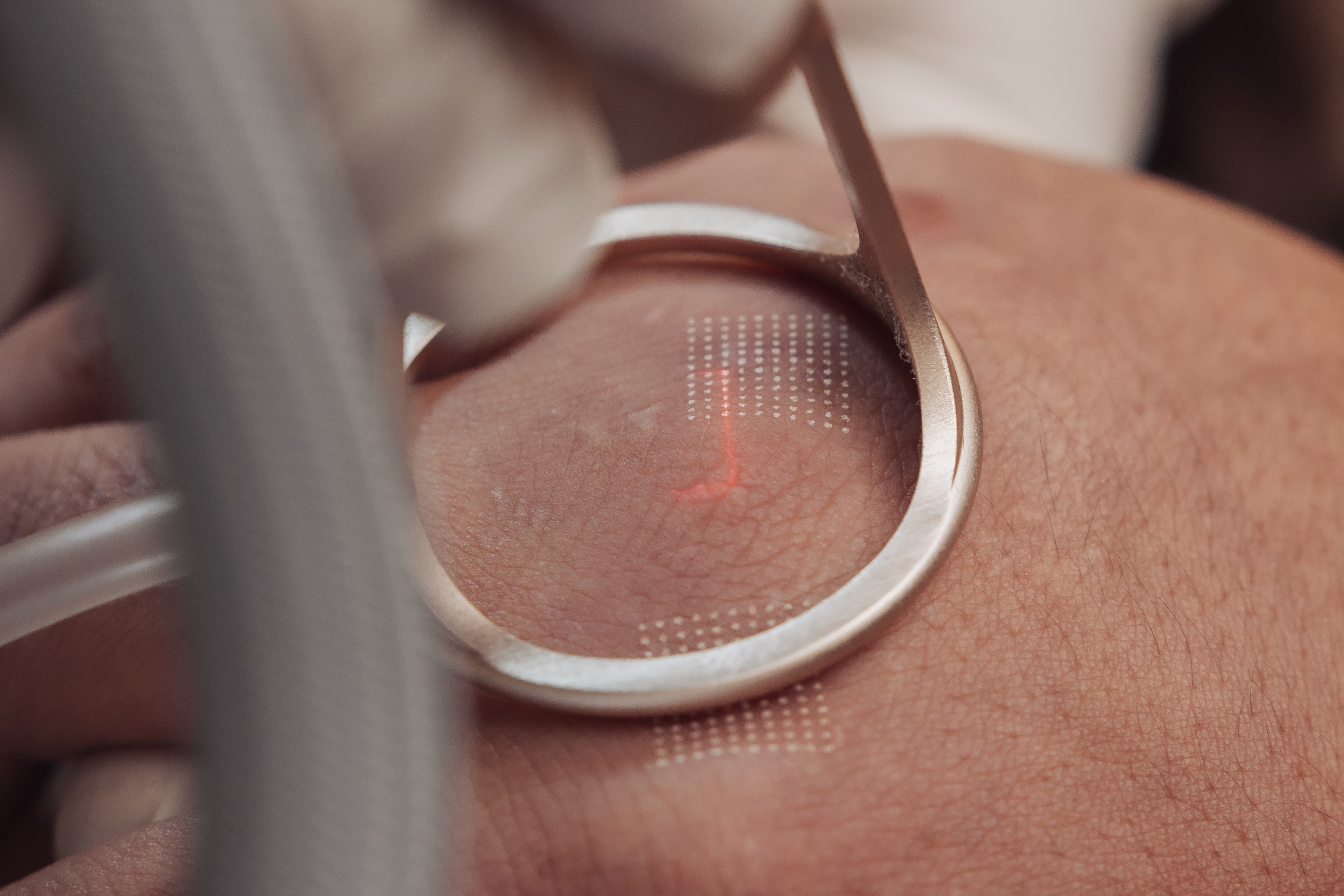 Close-up of a fractional laser handpiece with a red guide light being applied to a patient's skin during a treatment