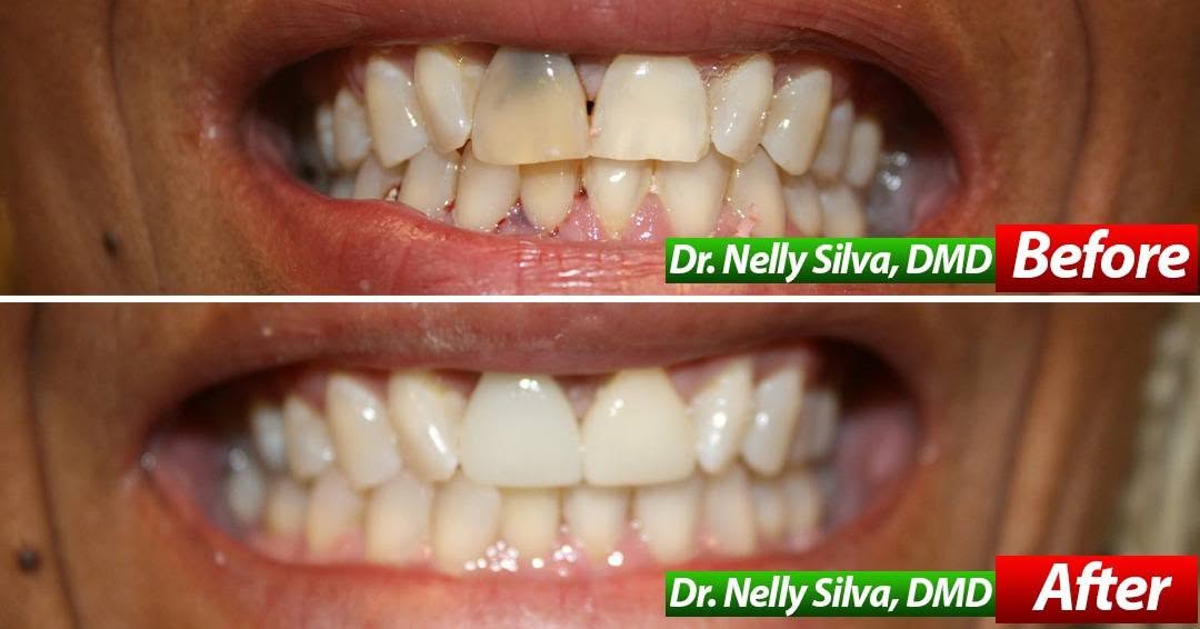 Before and after of a darkened, damaged front tooth restored to a natural shade