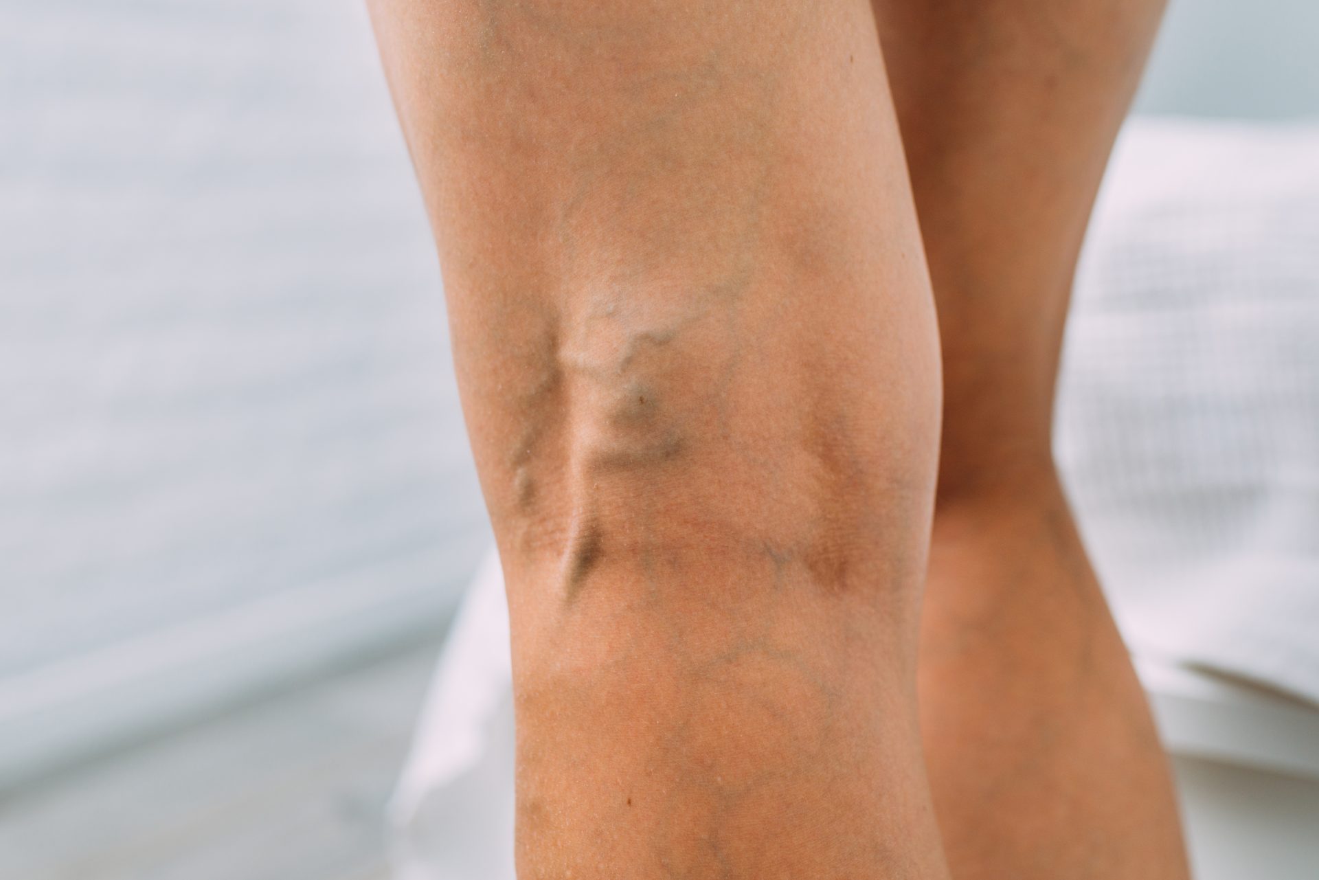Close-up of the back of a person's legs showing visible varicose veins