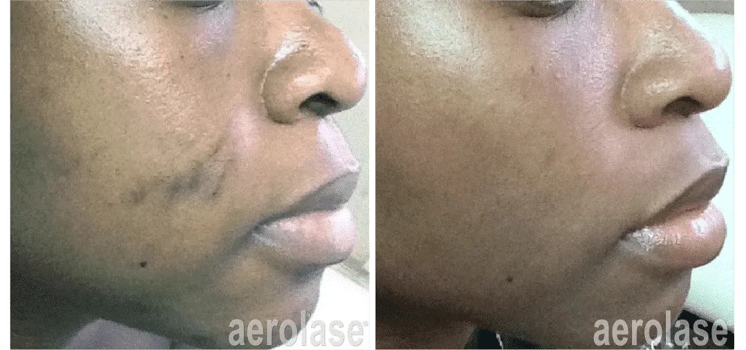 Before and after laser treatment: side view of a woman's cheek with acne scarring and dark marks, then smoother, more even skin