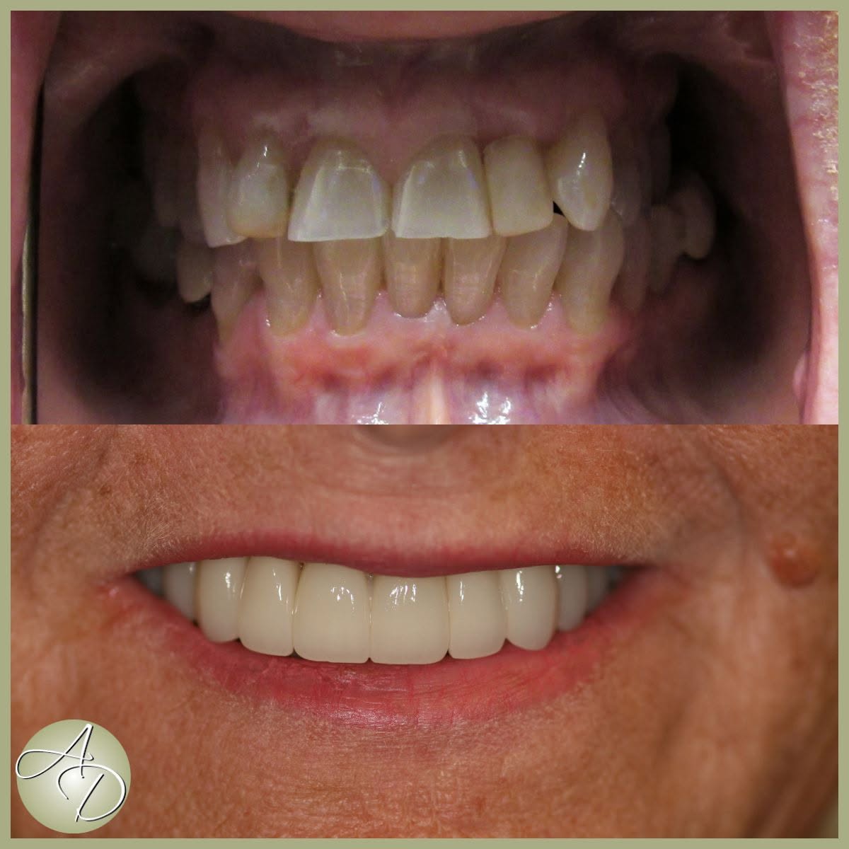 Before dental crowns: worn, chipped and uneven upper teeth