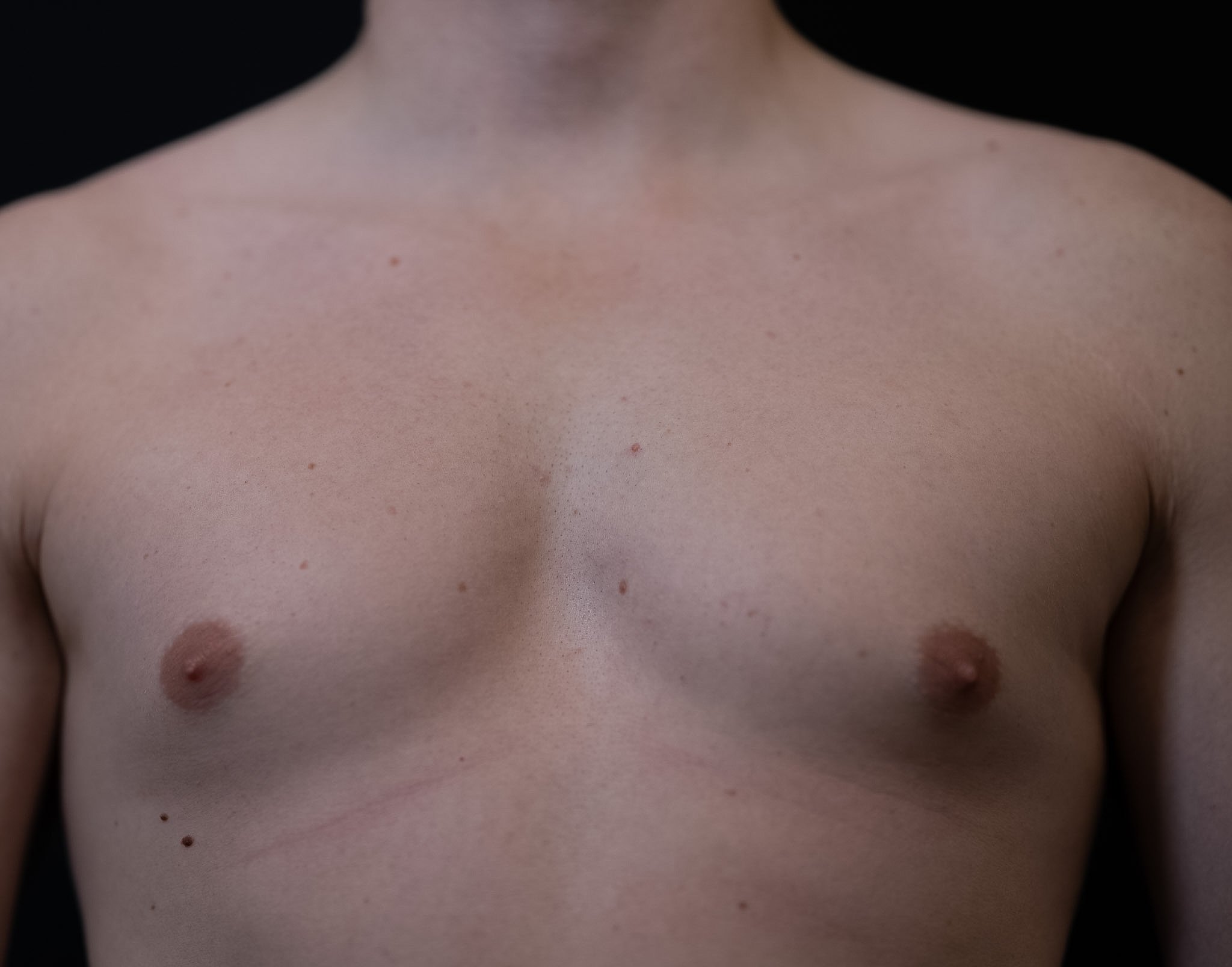 Front view of a man's flat, healed chest against a black backdrop, with faint scars along the lower chest