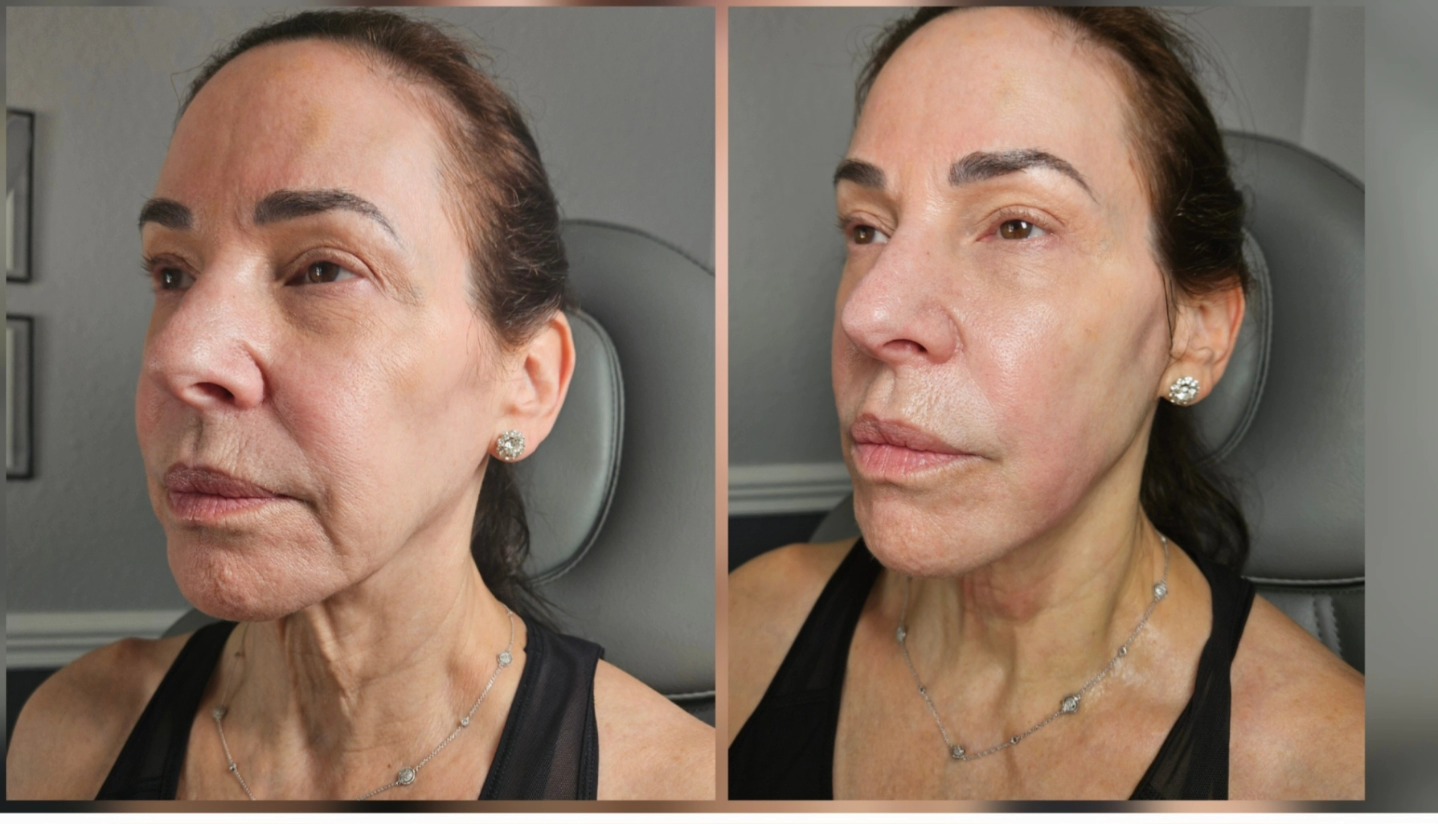 Non-surgical facelift in Boca Raton at Anti Aging Center of Boca