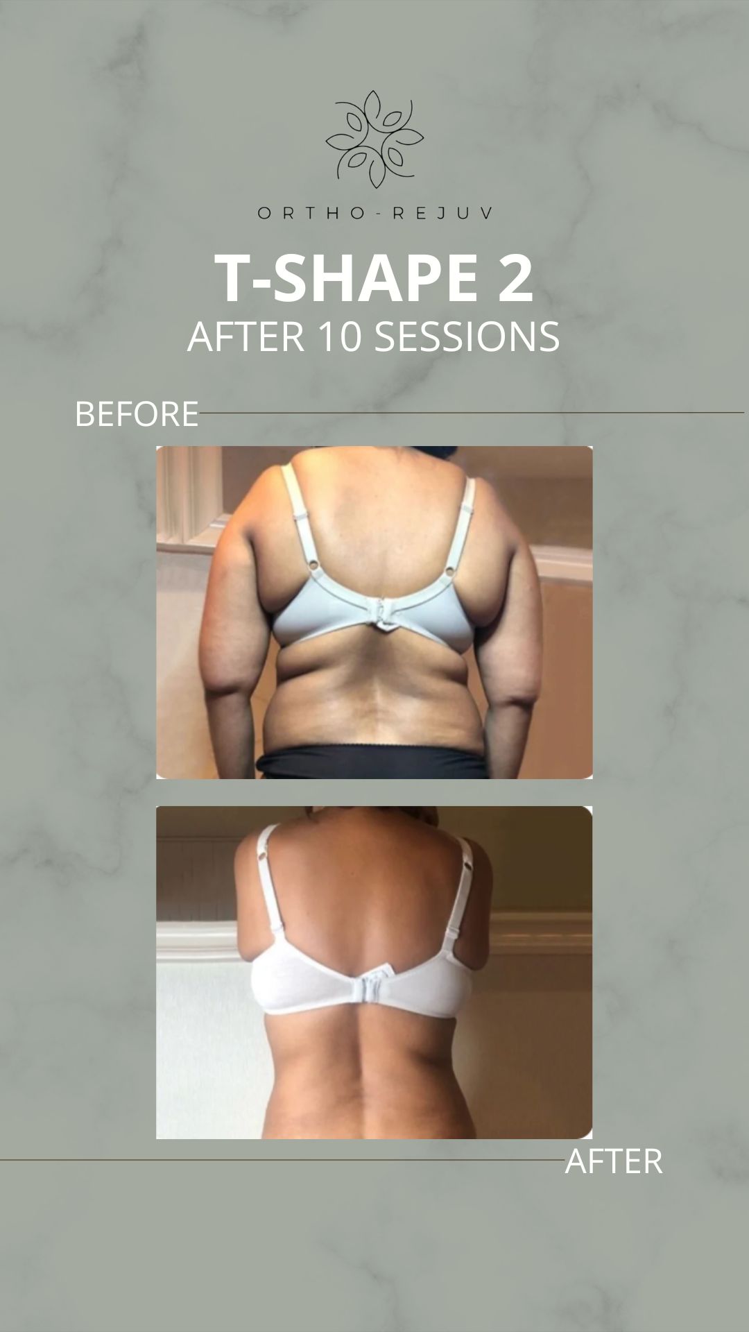 Before T-Shape 2: a woman's back and flanks showing soft fat rolls around the bra line