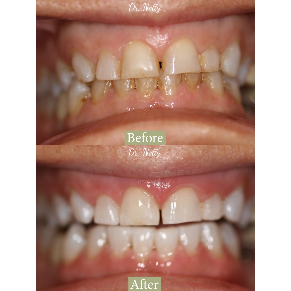 Before and after: worn, chipped and stained lower front teeth rebuilt with smooth, even edges by Dr. Nelly Silva