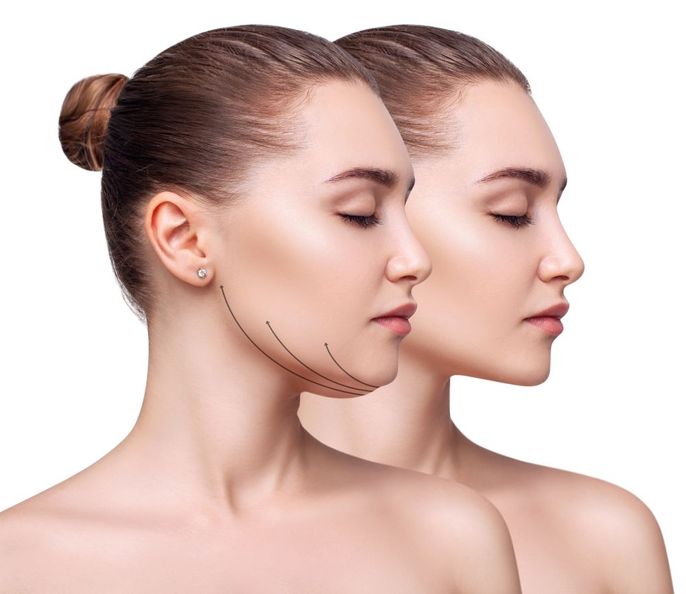 Side profile of a woman's face and neck with arrows illustrating a lifted, contoured jawline effect