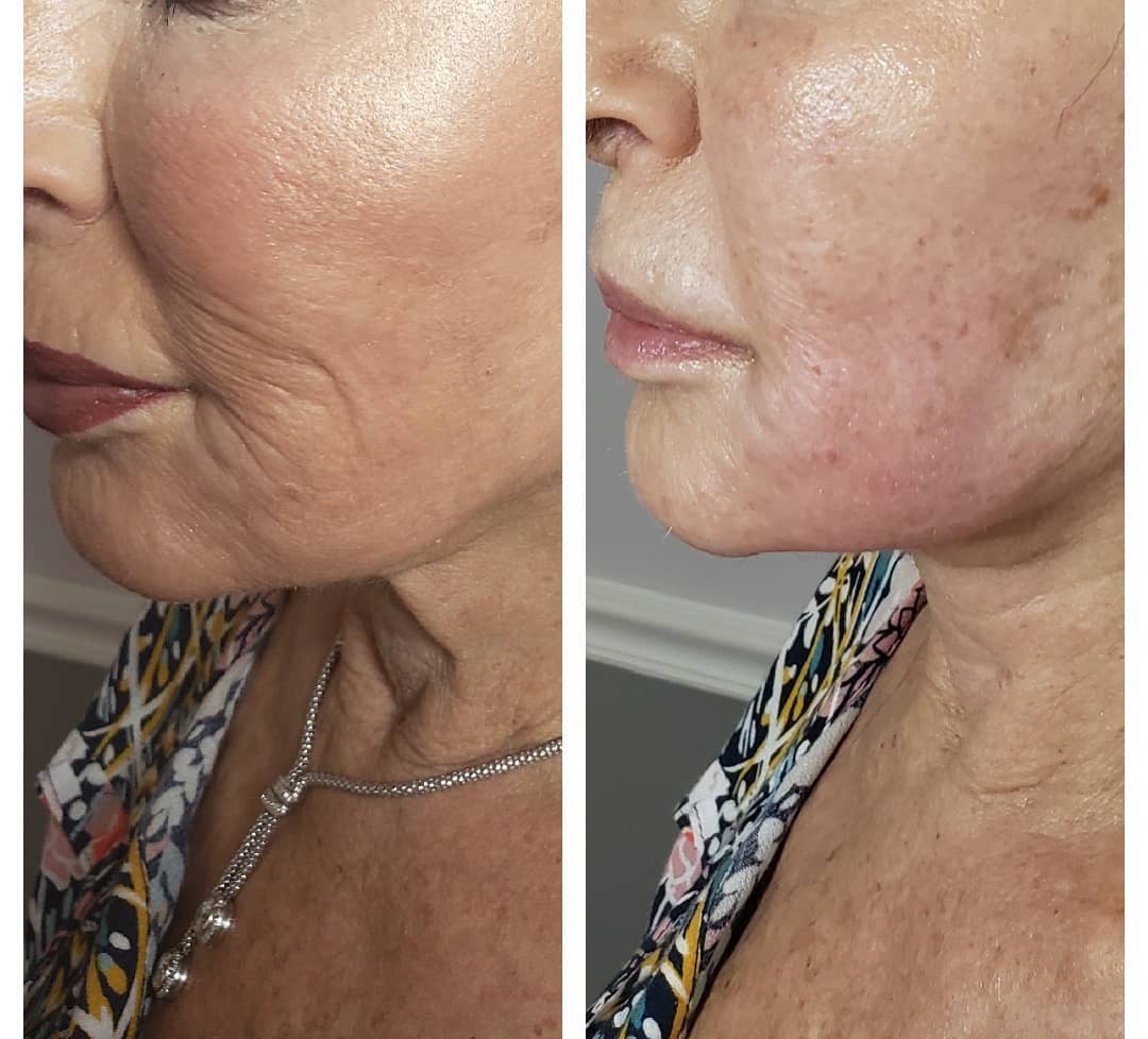 Side profile of an 83-year-old woman before and 40 minutes after a non-surgical necklift, with tighter skin along the jaw and neck