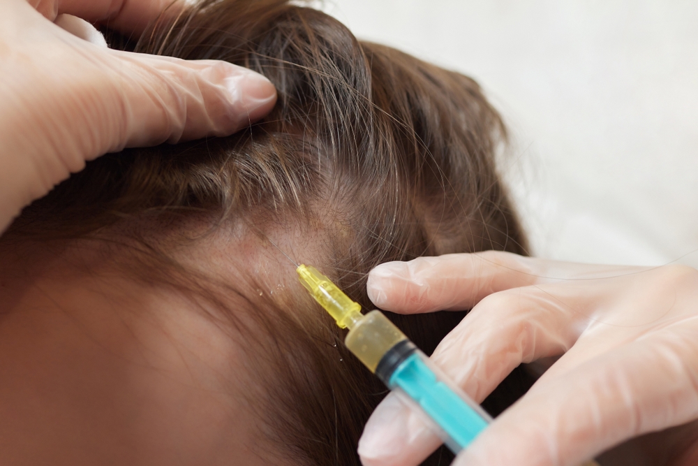 A gloved provider administers a scalp injection into a patient's hair for a hair restoration treatment