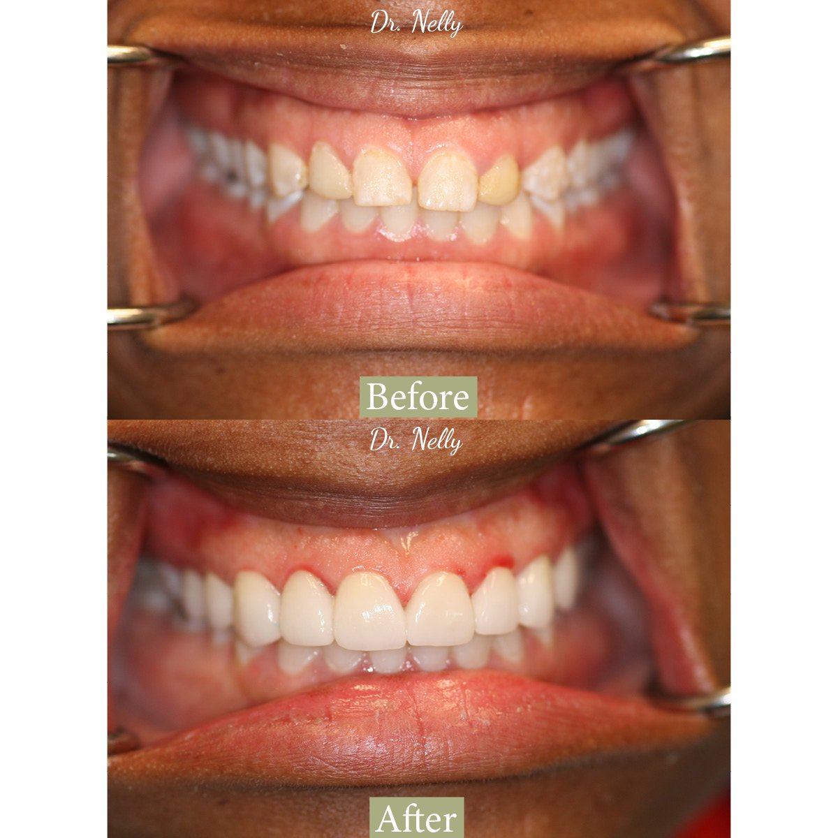 Before cosmetic restoration: uneven, mismatched front teeth