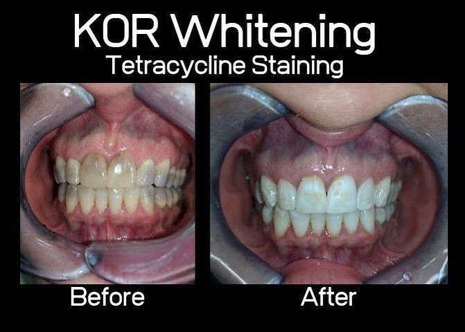 Before KöR whitening: front teeth with gray tetracycline staining