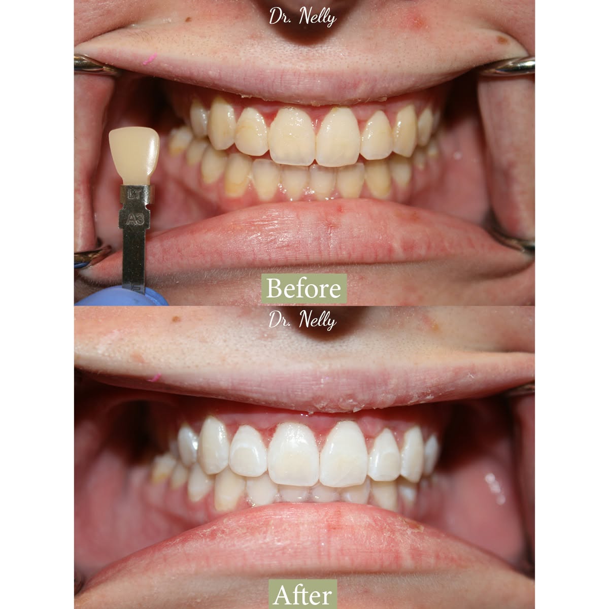 Before veneers: uneven, yellowed front teeth beside a shade tab