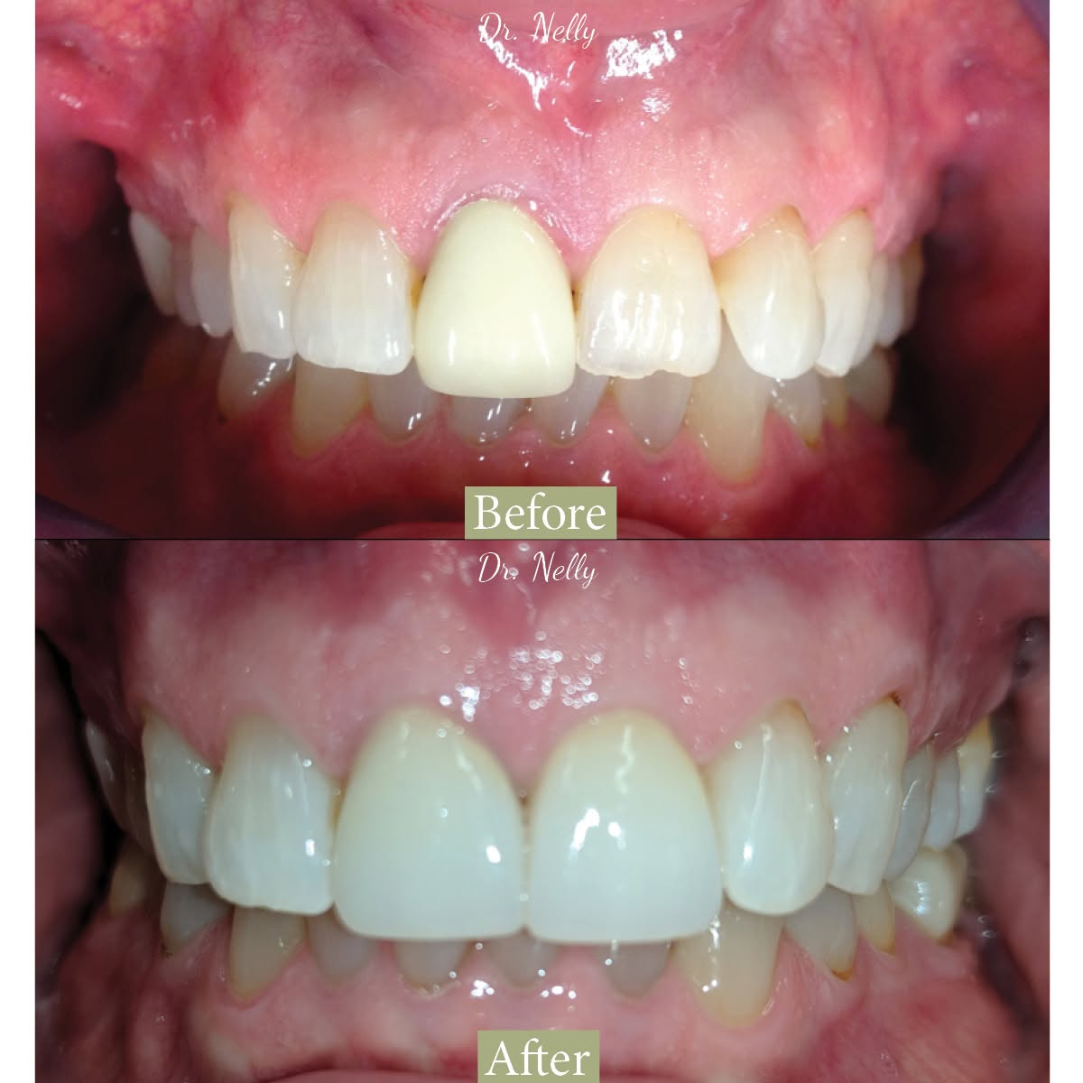 Before dental crowns: an old front crown that no longer matches the neighboring teeth
