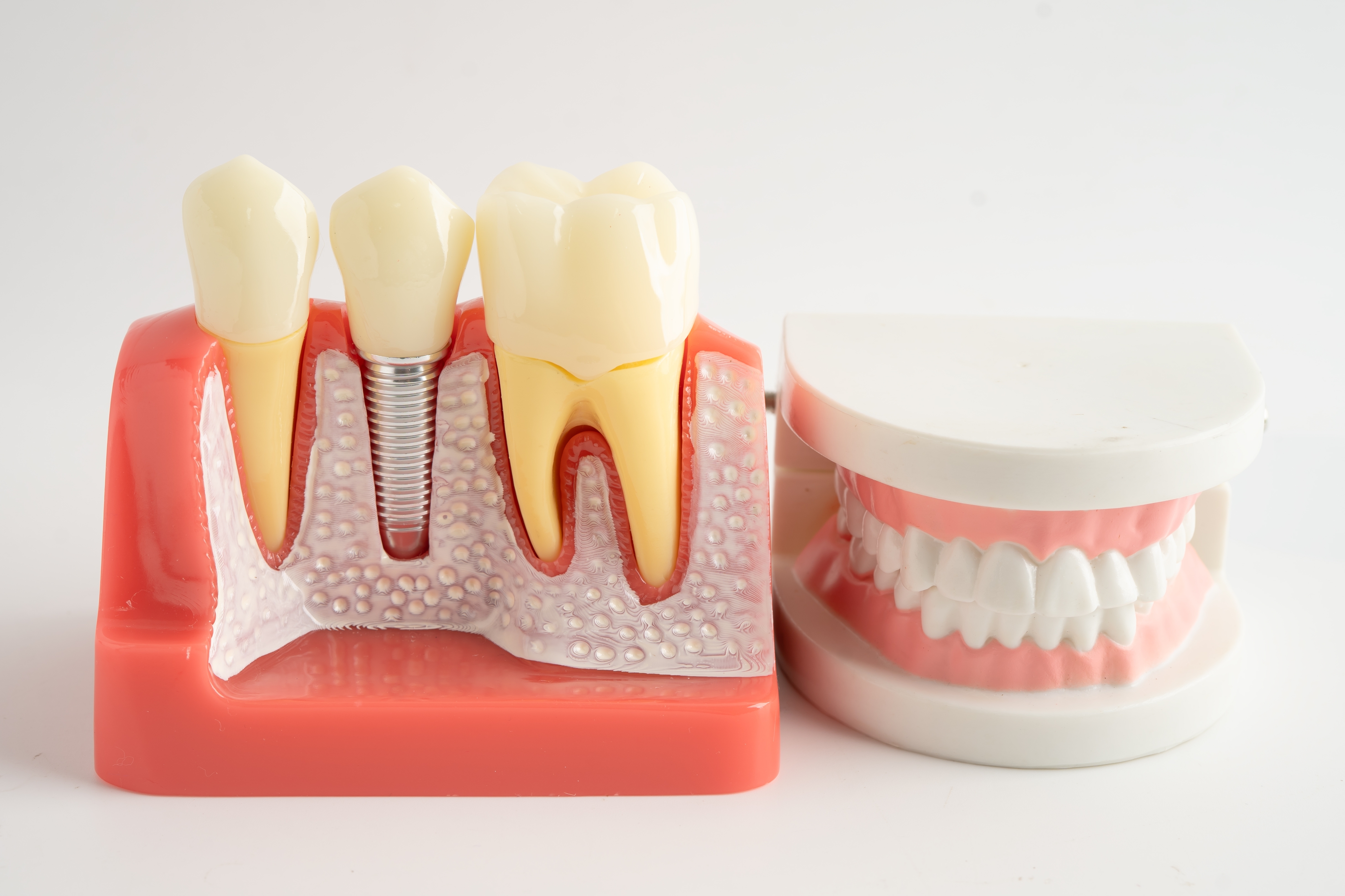 Teaching models comparing a dental implant with a traditional removable denture