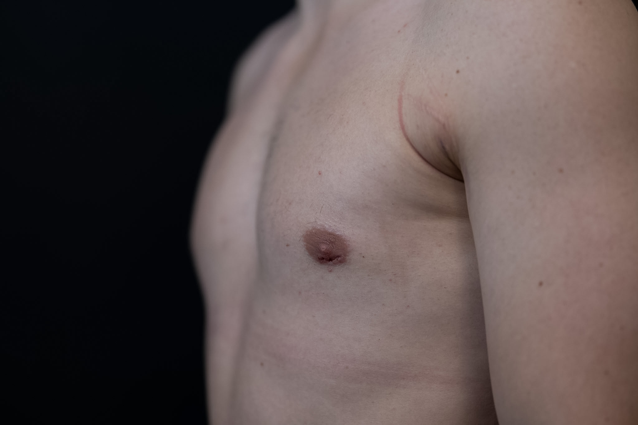 Side view of a man's chest after gynecomastia surgery, with a faint healed incision line, photographed against a black backdrop