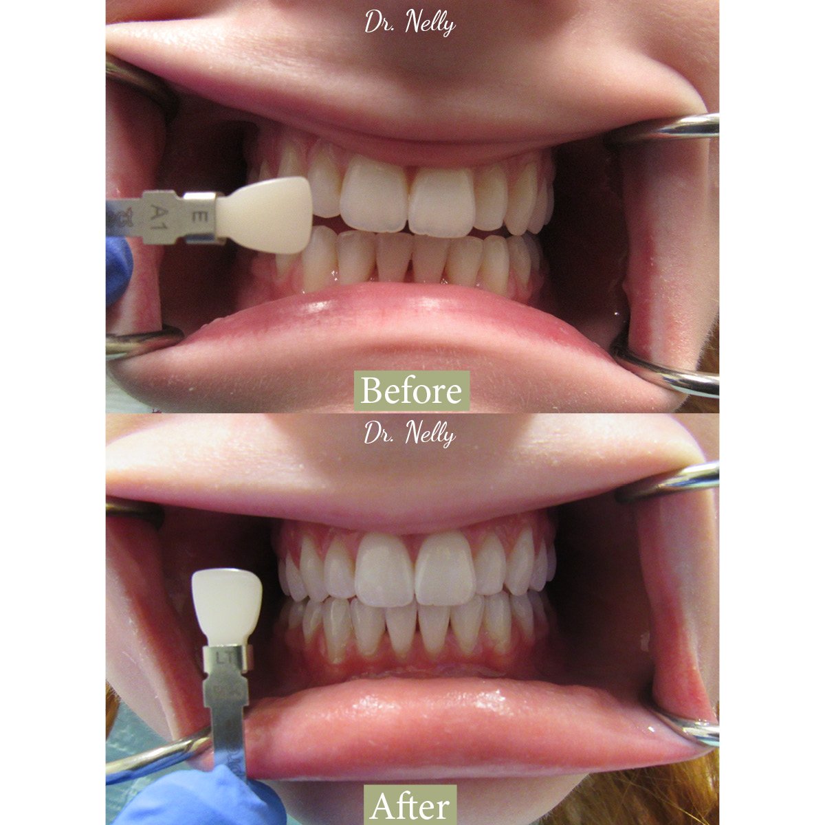Before and after shade change of a patient's front teeth, shown against a dental shade guide