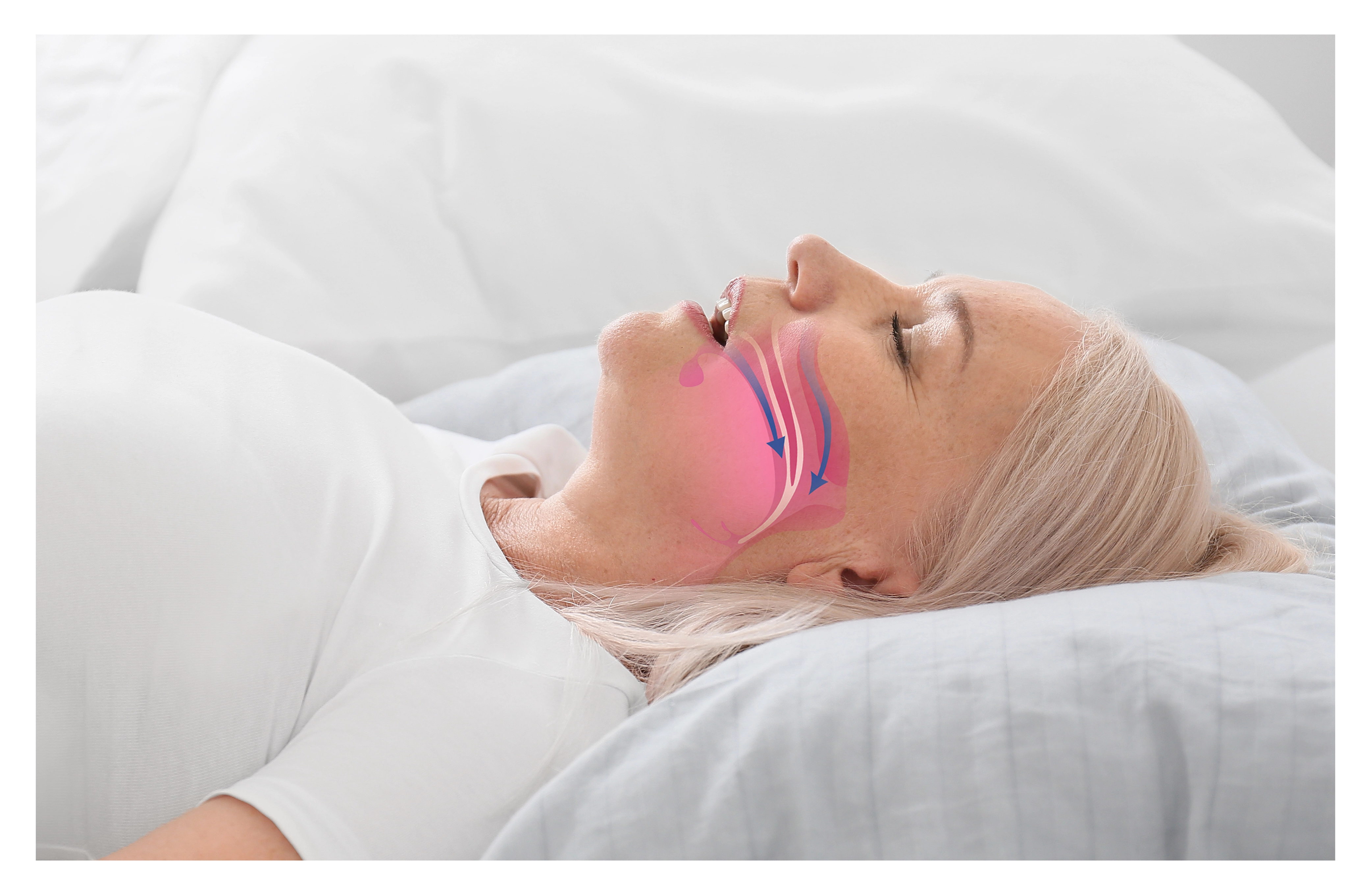 Illustration of a sleeping woman's narrowed airway, the obstruction that sleep apnea treatment keeps open