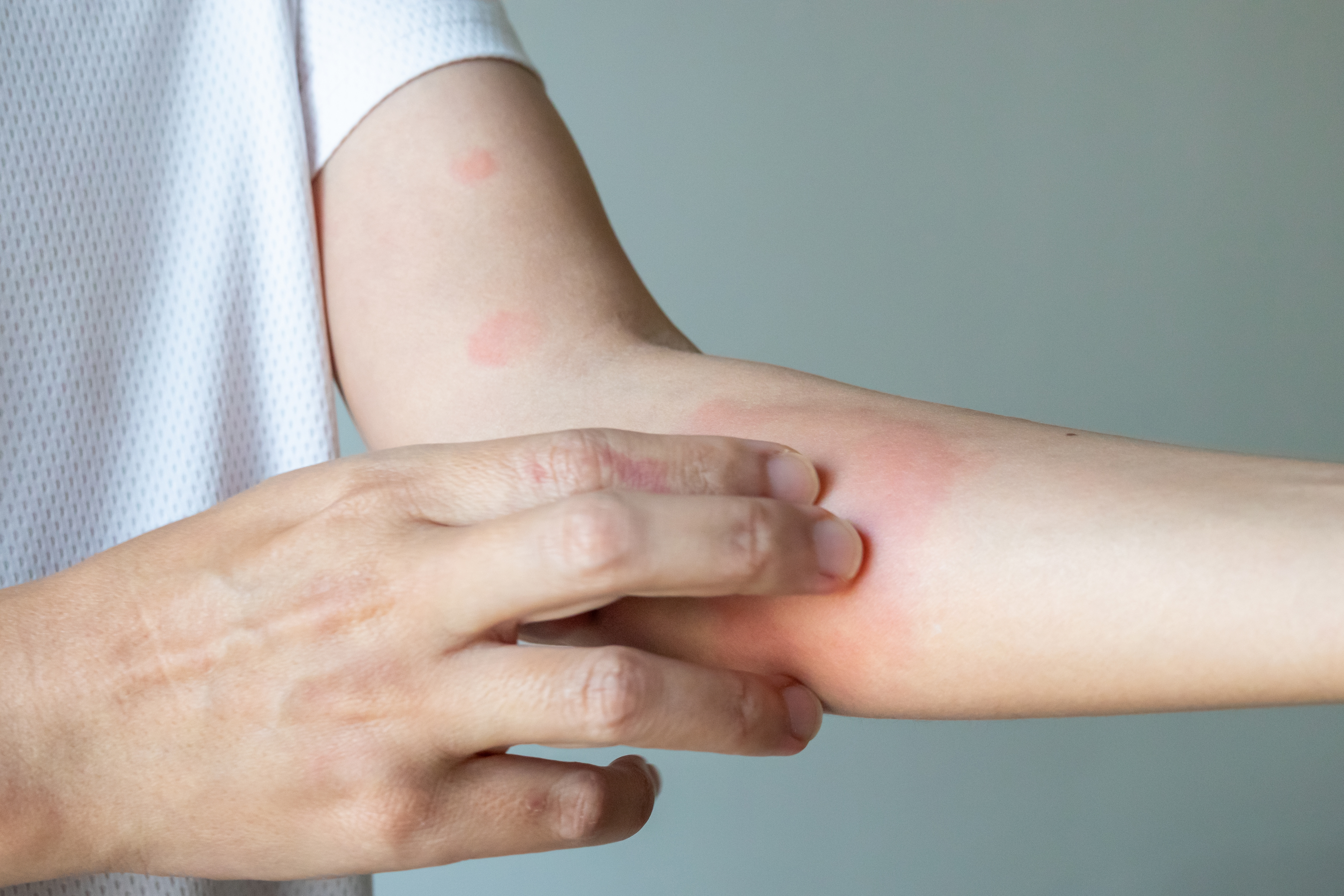Close-up of a person scratching an irritated red patch on the forearm, a skin allergy symptom
