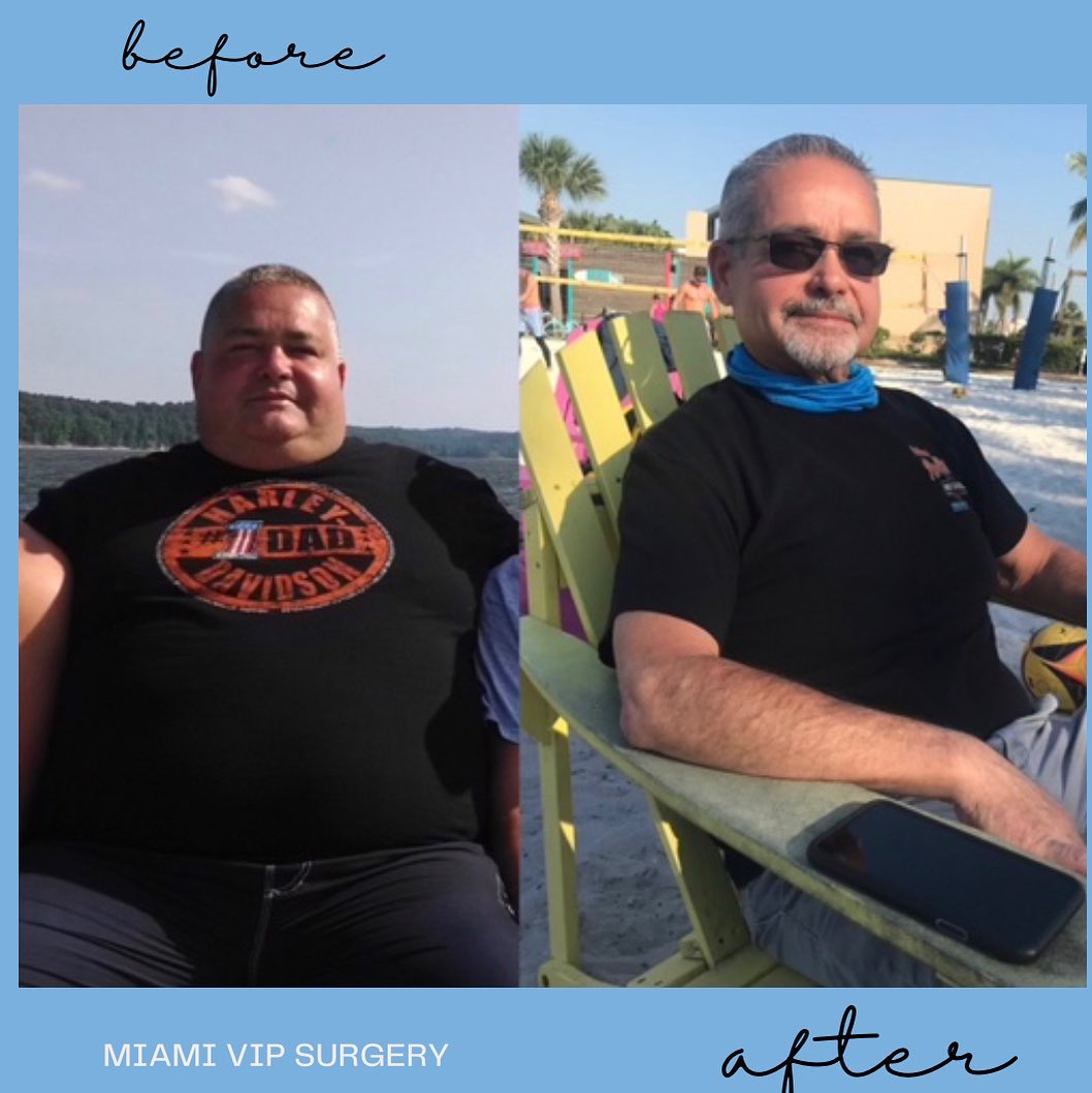 Man in a black t-shirt seated outdoors before bariatric surgery, then visibly slimmer sitting in a beach chair