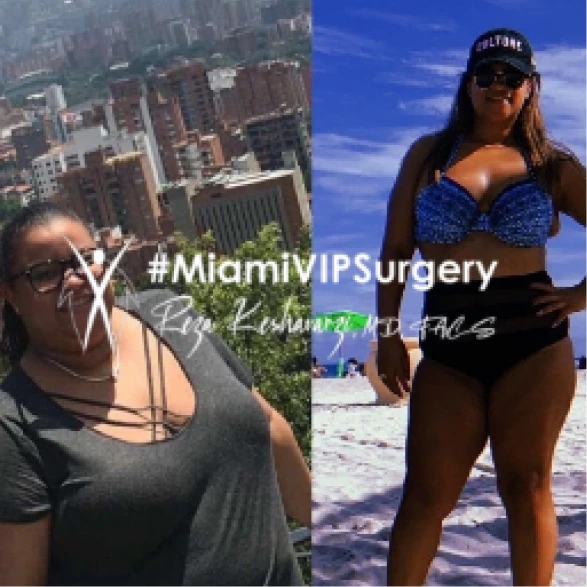 Gastric sleeve before and after of a woman in a gray top, then slimmer in swimwear on the beach