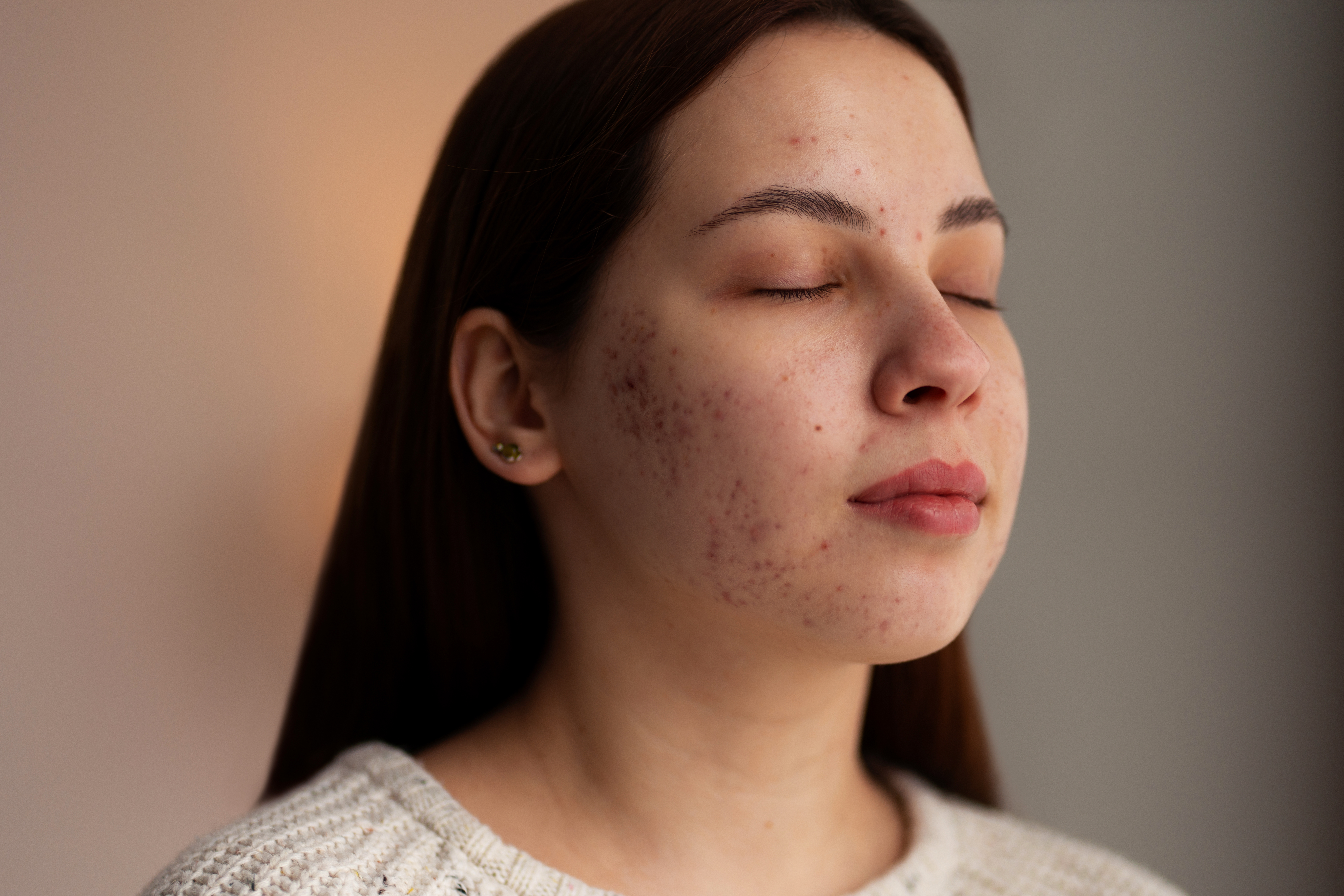 A young woman with closed eyes shows visible acne and acne scarring on her cheek in a softly lit close-up portrait