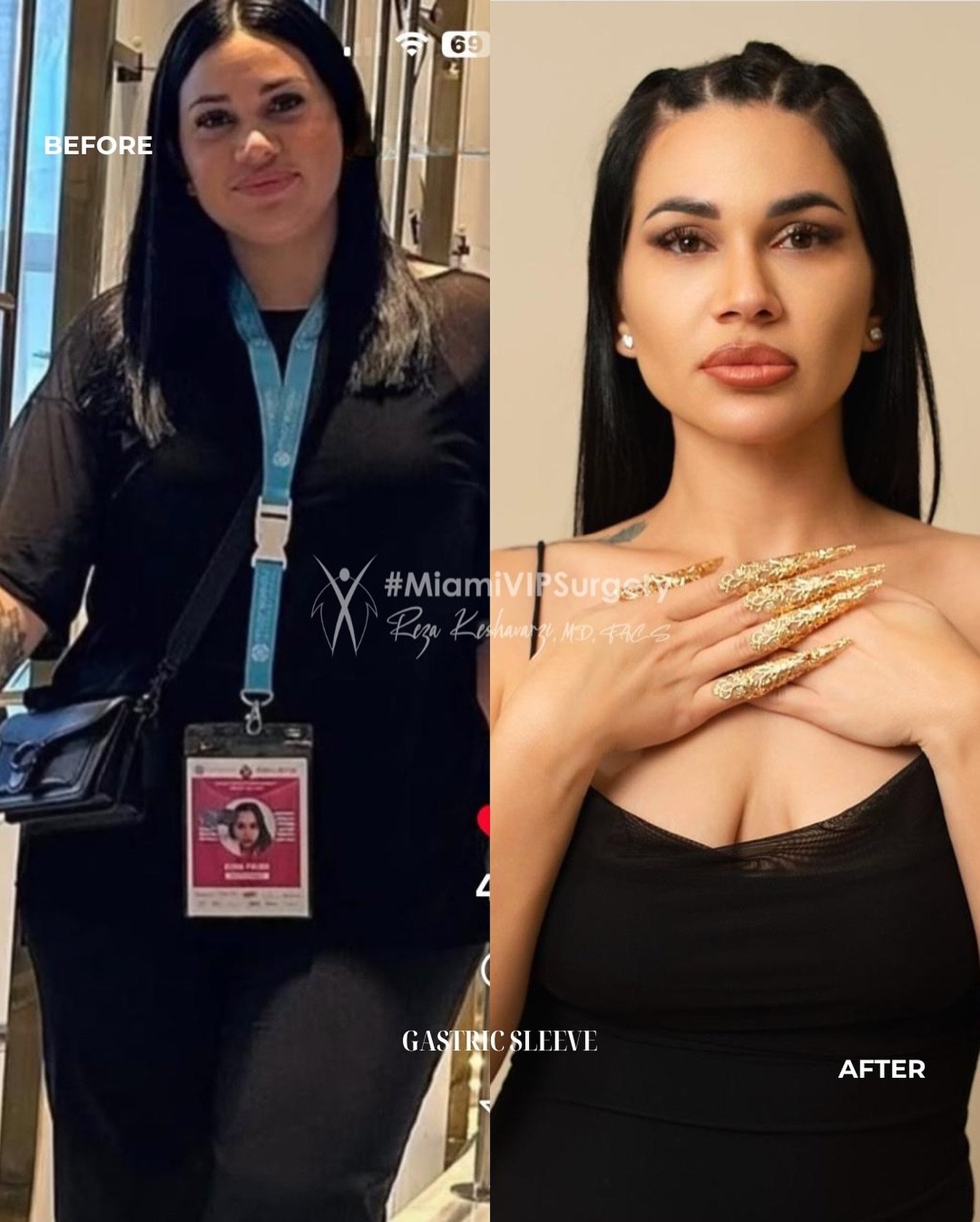 Before and after gastric sleeve surgery: a woman wearing a lanyard, then slimmer in a black top