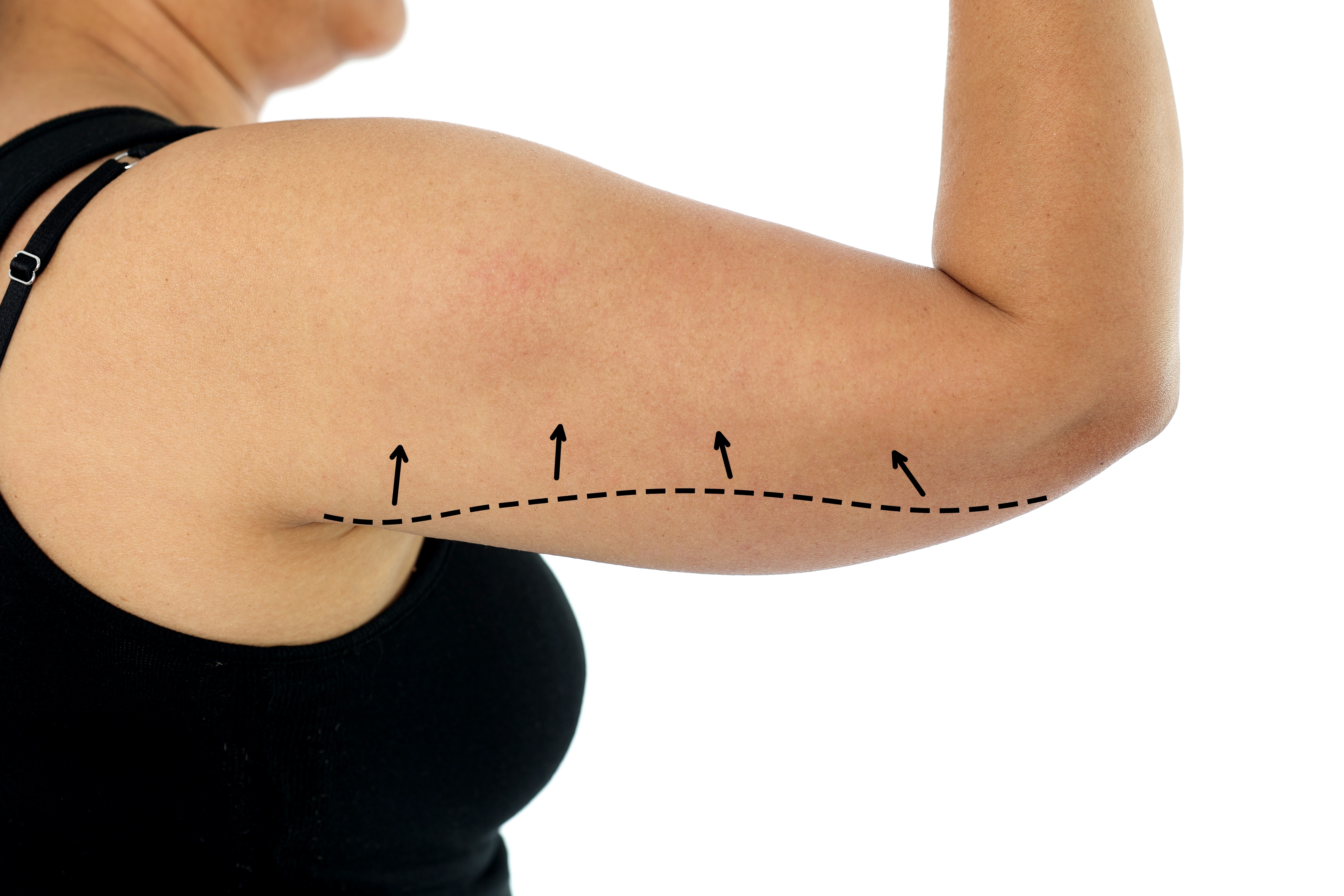 Close-up of a woman's upper arm with surgical marking arrows indicating arm lift or liposuction treatment area, from a blog p