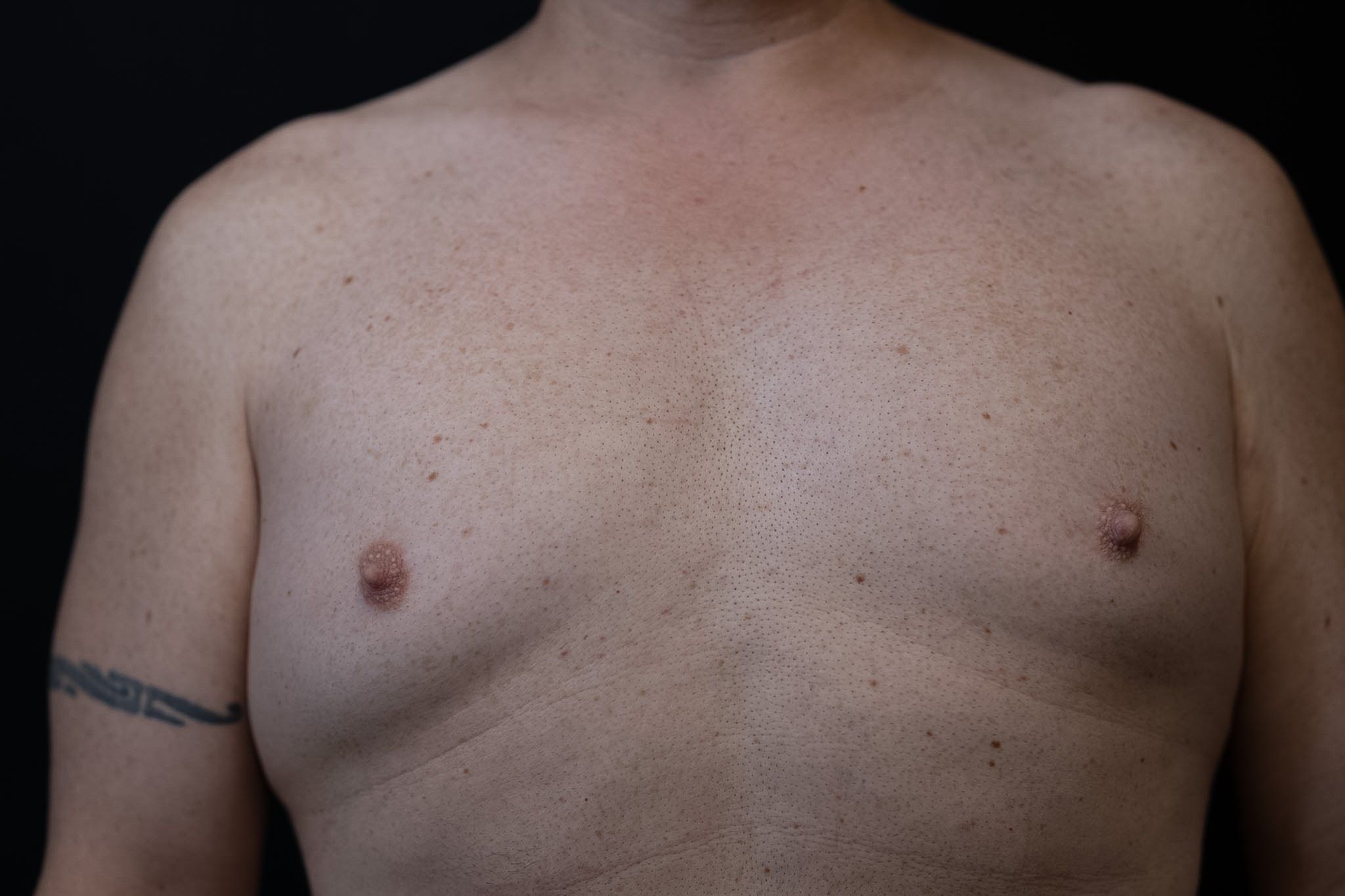 Front view of a man's bare chest showing soft fullness around both nipples, photographed against a black backdrop