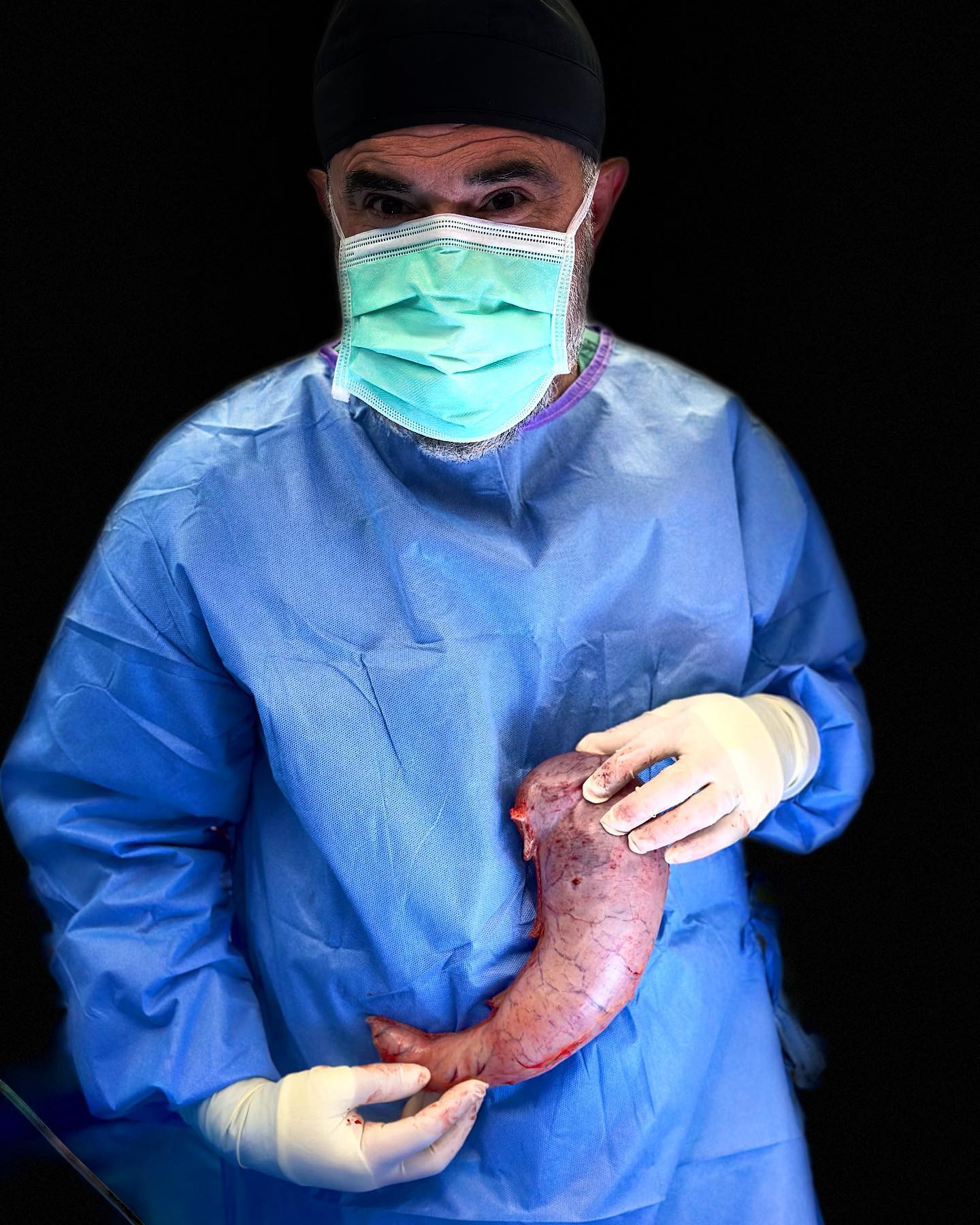 Dr. Keshavarzi in surgical cap, mask and blue gown holding the portion of stomach removed during a gastric sleeve