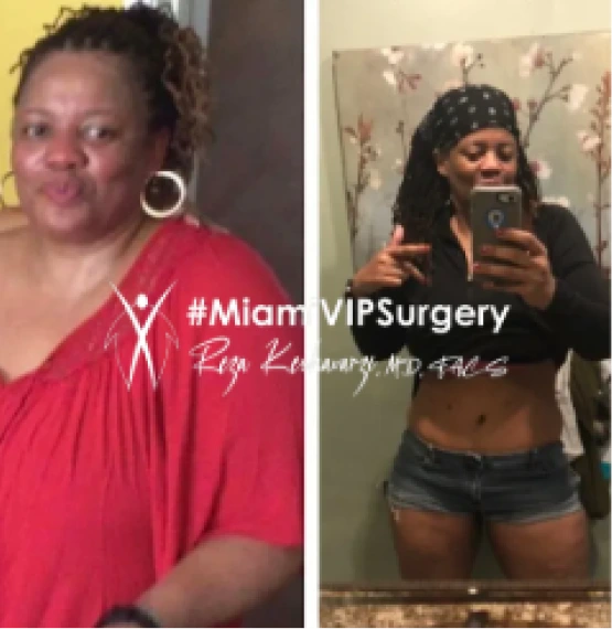 Before and after bariatric surgery: a woman in a red top, then slimmer in a black crop top and shorts