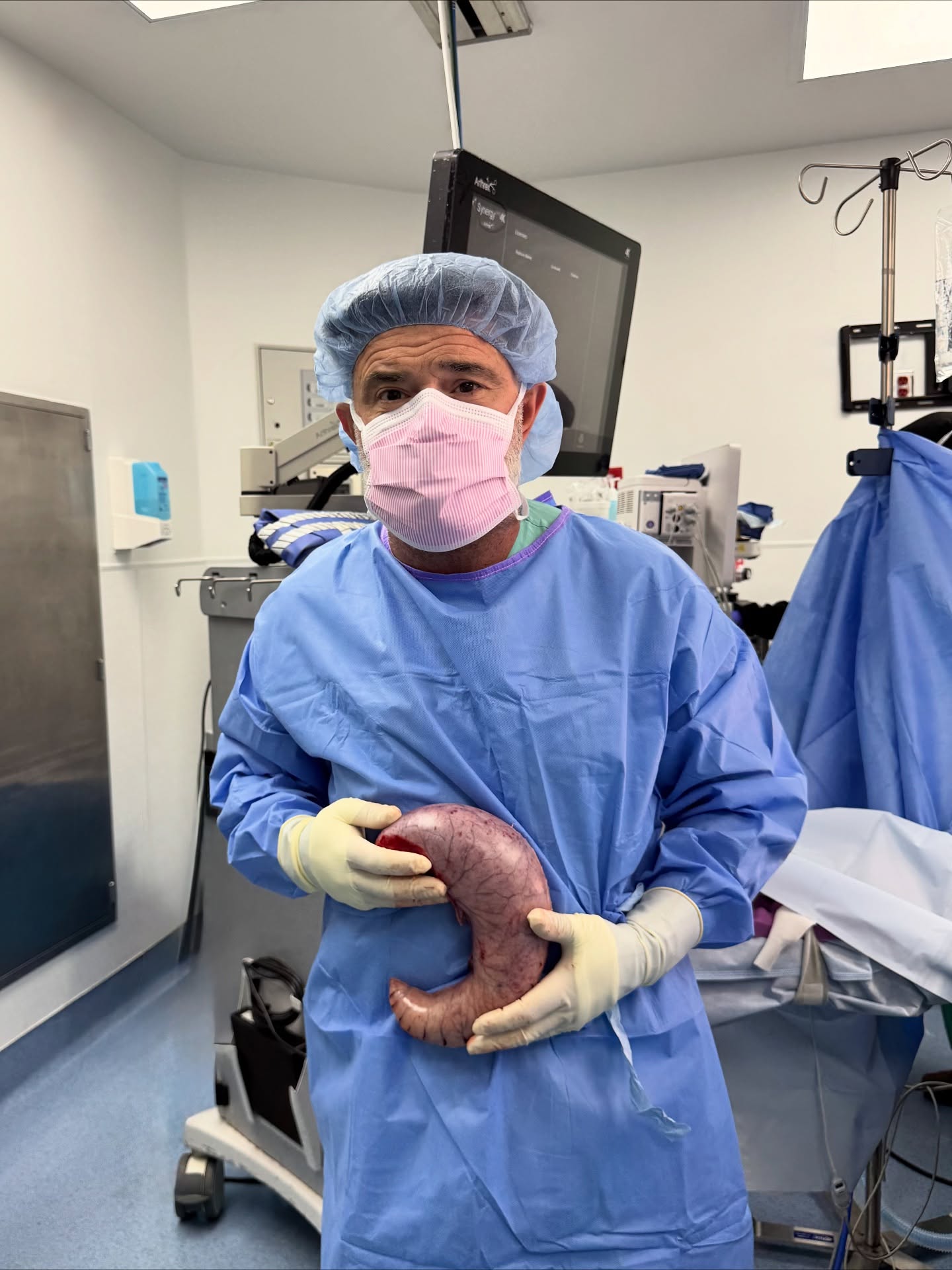 Surgeon in an operating room holding the portion of stomach removed during gastric sleeve surgery