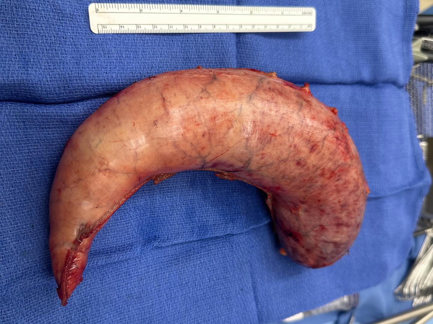 Portion of stomach removed during a gastric sleeve, laid on a blue surgical drape beside a ruler