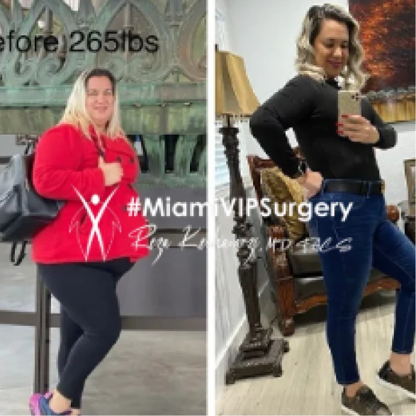 Before and after bariatric surgery: a woman in a red jacket, then slimmer in a black top and jeans