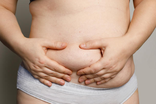 A woman pinches excess fat on her abdomen with both hands, highlighting concerns about belly fat or loose skin