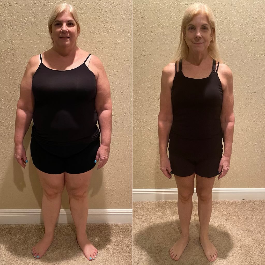 Gastric sleeve patient before surgery and one year after, standing in the same black tank top