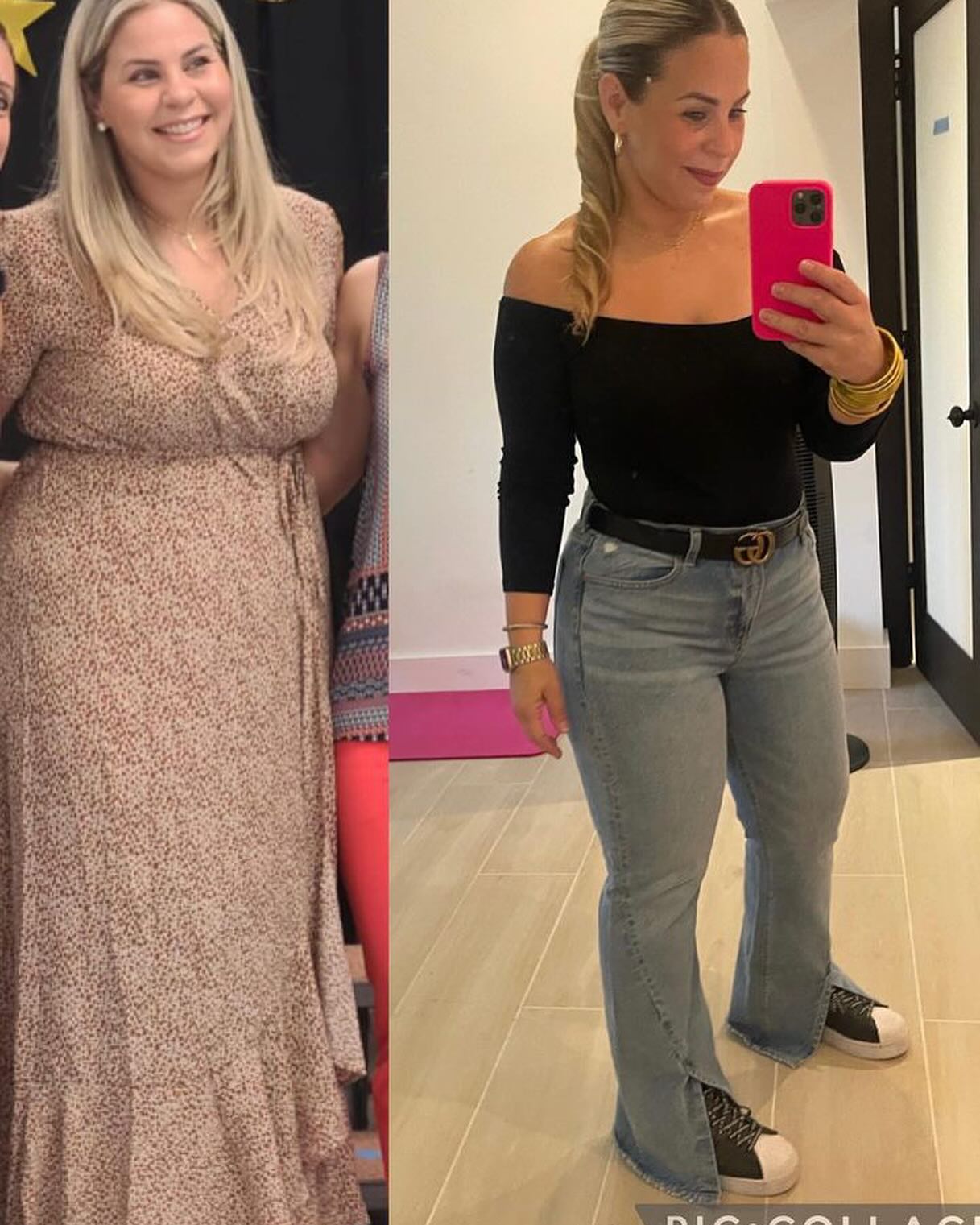 Bariatric surgery patient before surgery in a floral dress, left, and after weight loss in jeans and a black top, right