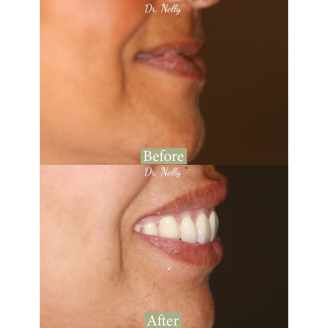 Before smile makeover, side profile of the lips and teeth