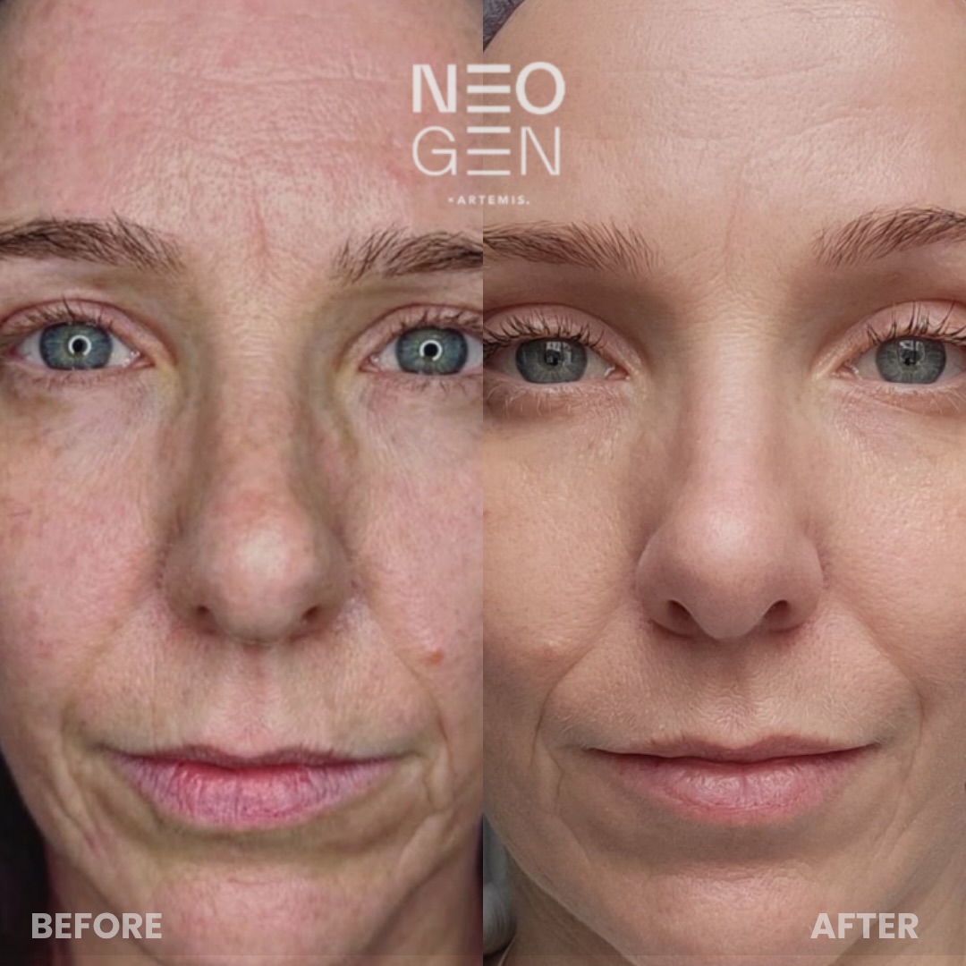 Close-up of a woman's forehead, eyes and mouth before and after NeoGen, with finer forehead lines and smoother texture