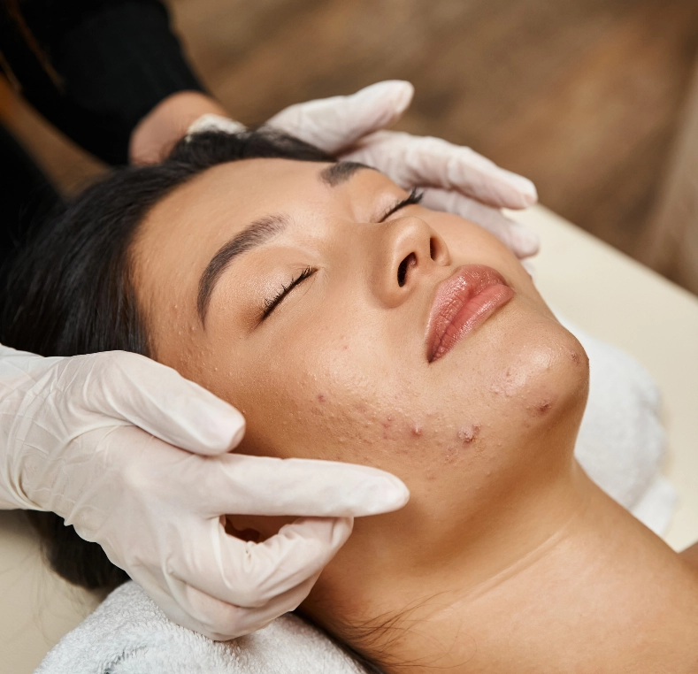 A gloved provider examining acne-prone skin on the cheek and jaw during a facial assessment