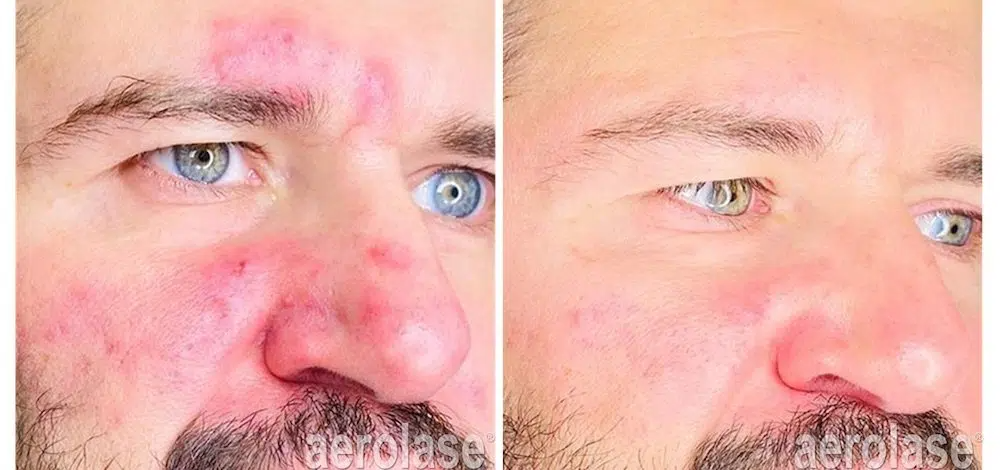 Before and after close-up of a man's nose, cheeks and forehead showing reduced rosacea redness after Aerolase Neo