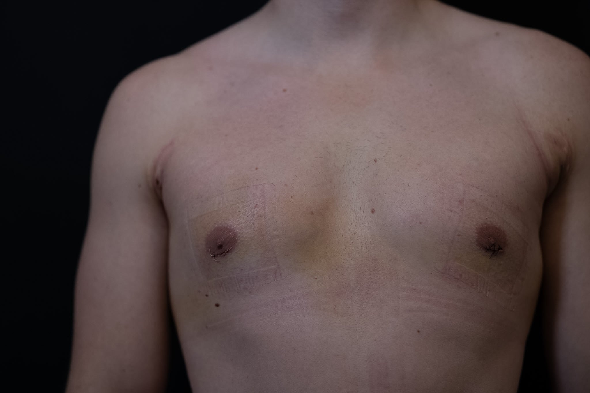 Front view of a man's chest in early recovery, with small dressings at the edge of each areola