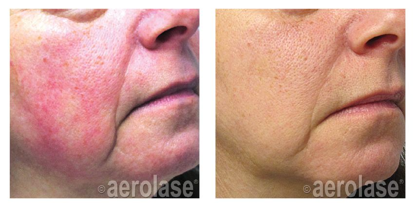 Before and after close-up of a woman's cheek showing diffuse facial redness reduced after Aerolase Neo laser treatment