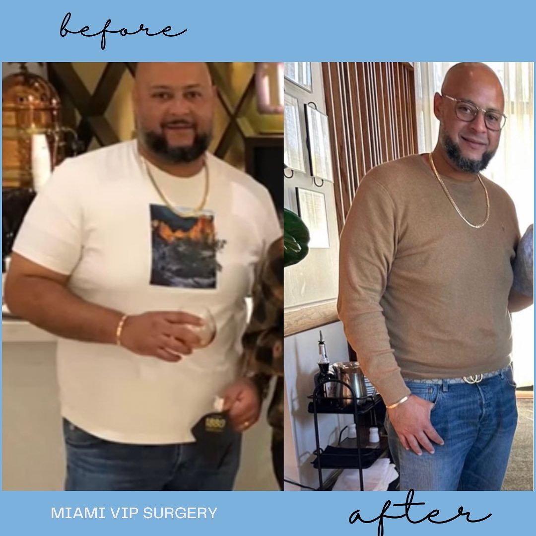 Before and after gastric sleeve surgery: a male patient in a white t-shirt before and noticeably slimmer in a tan sweater after