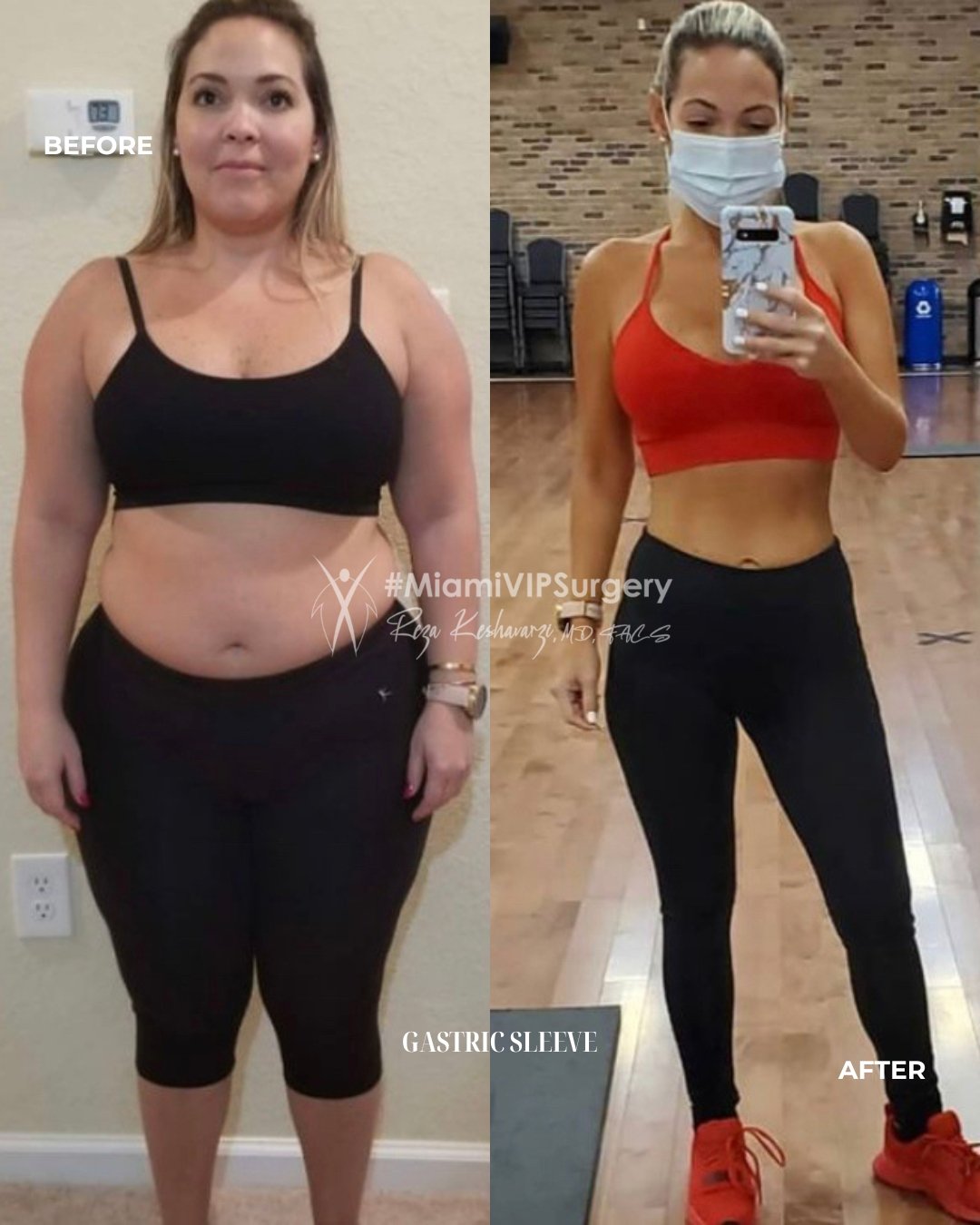 Before and after gastric sleeve, woman in workout clothes showing a slimmer waist after surgery