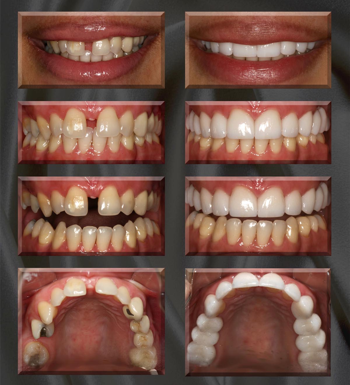 Before full arch crowns: upper arch with broken and heavily filled back teeth