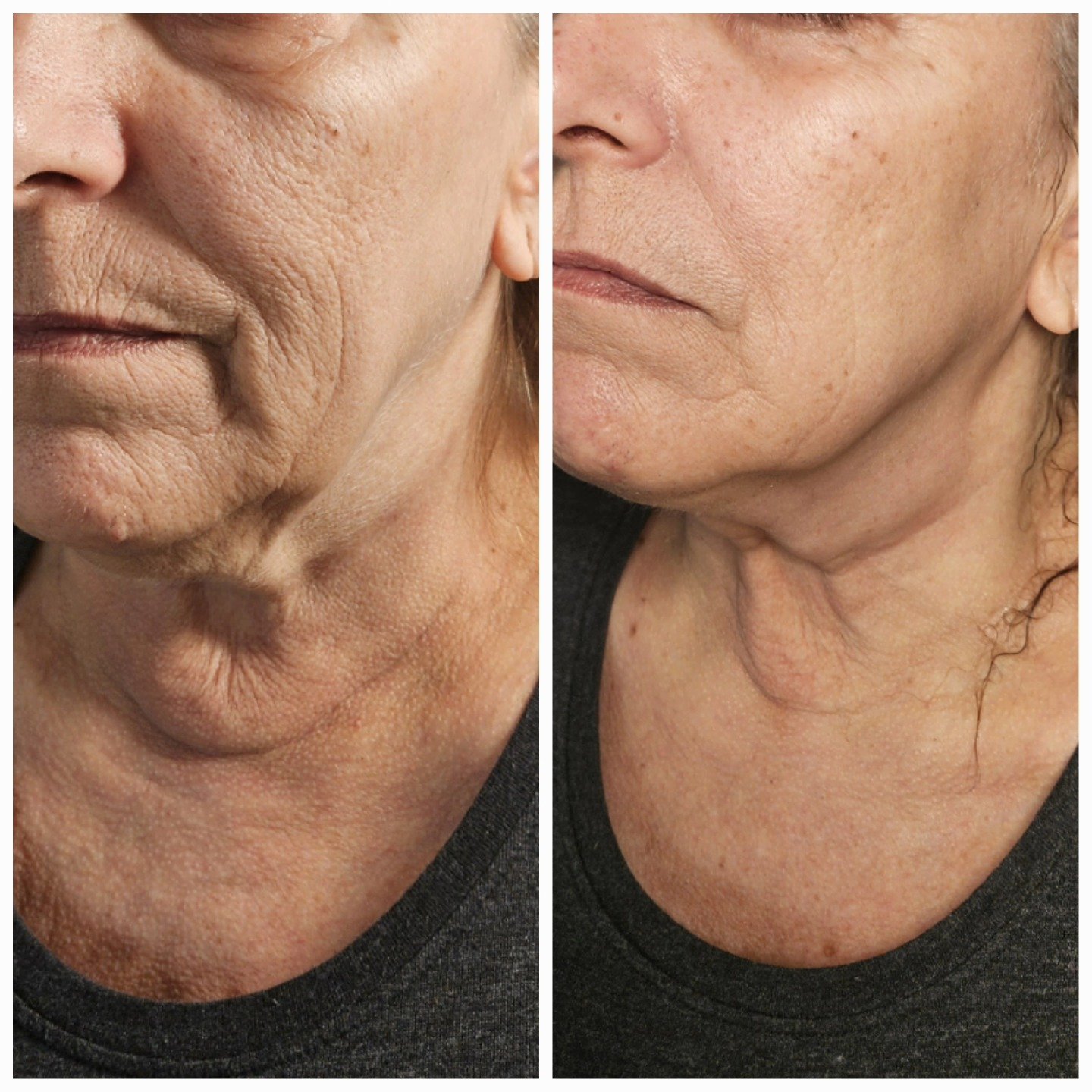 A woman's lower face and neck before and after one non-surgical necklift session, with smoother neck skin and a cleaner jawline