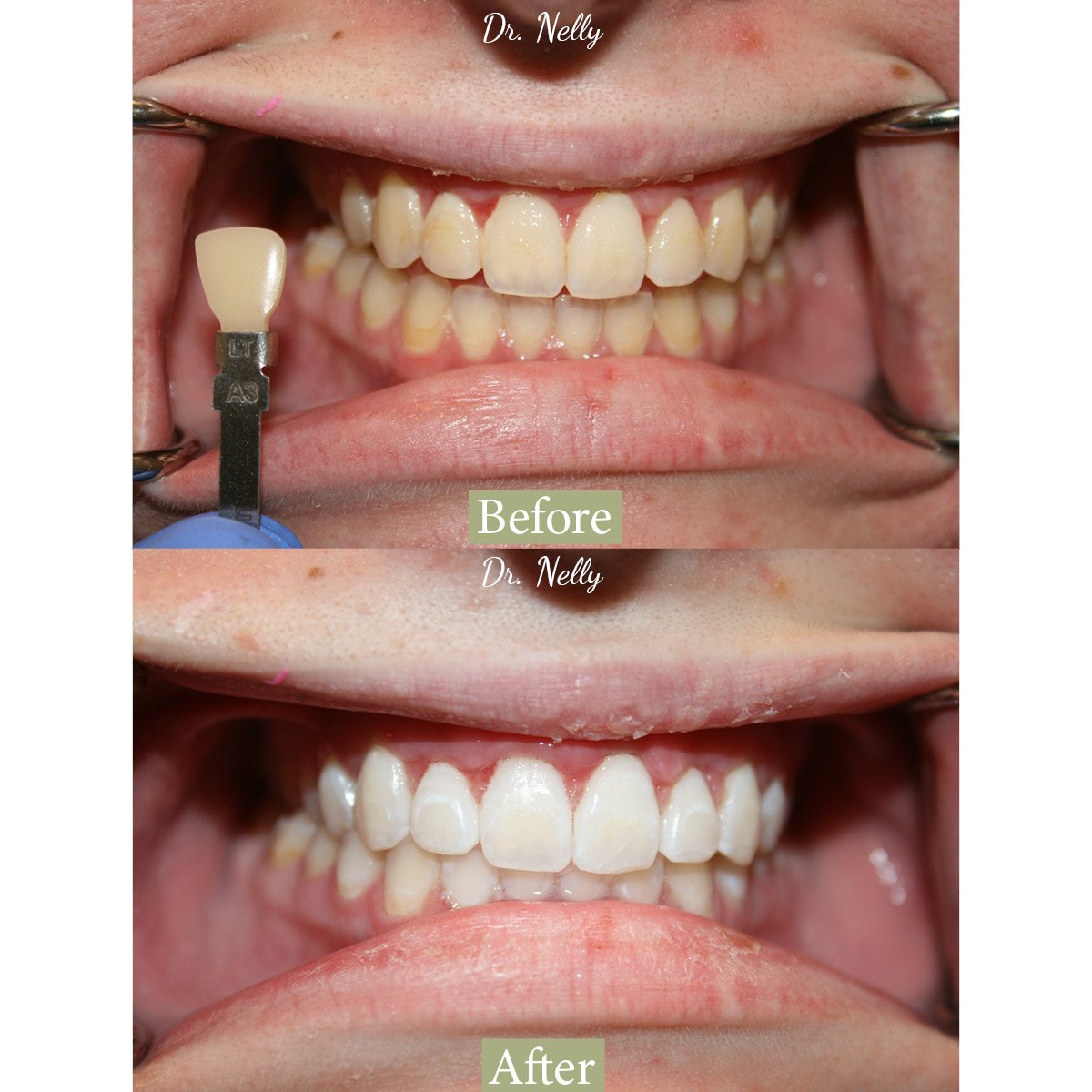 Before whitening and shade matching, with a shade tab beside the teeth