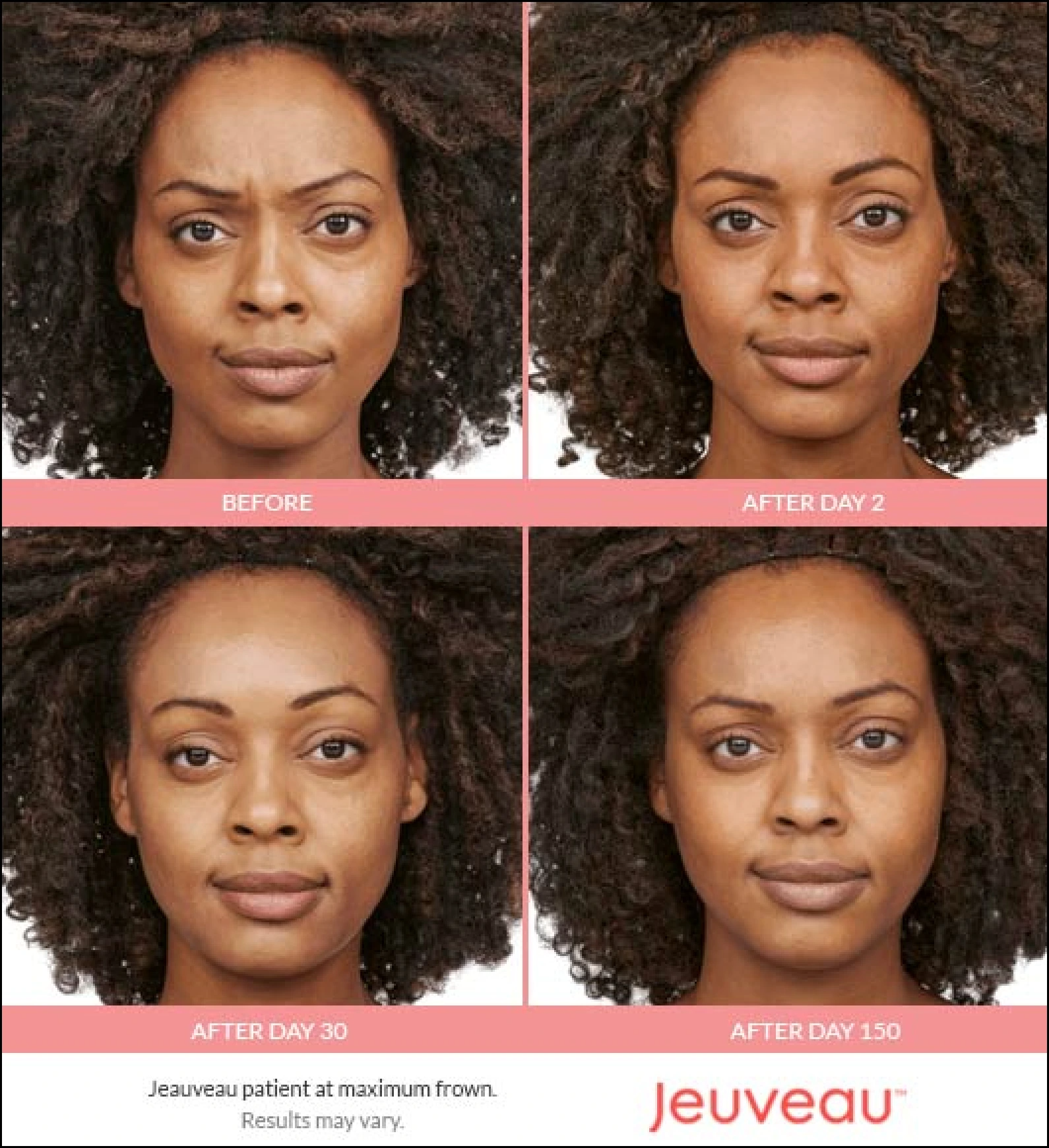 Woman with deep brown skin shown before Jeuveau and at day 2, 30 and 150 after, with frown lines between the brows softened