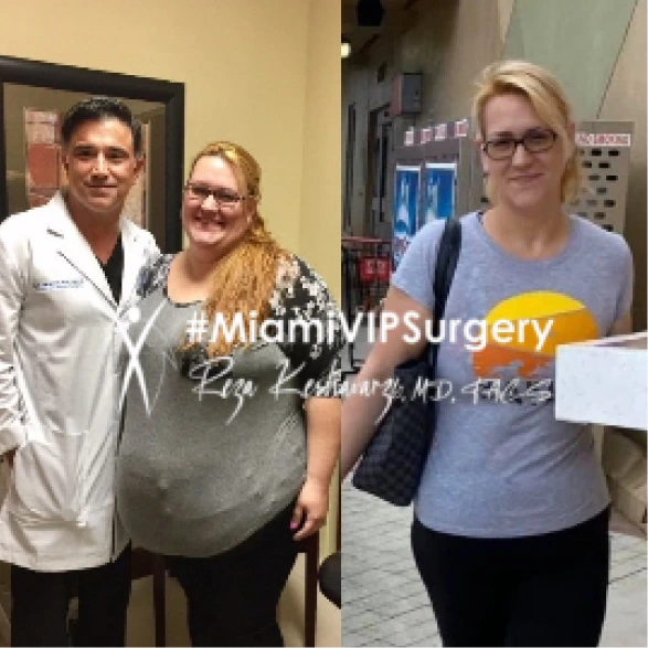 Before and after gastric sleeve surgery, female patient with Dr. Keshavarzi