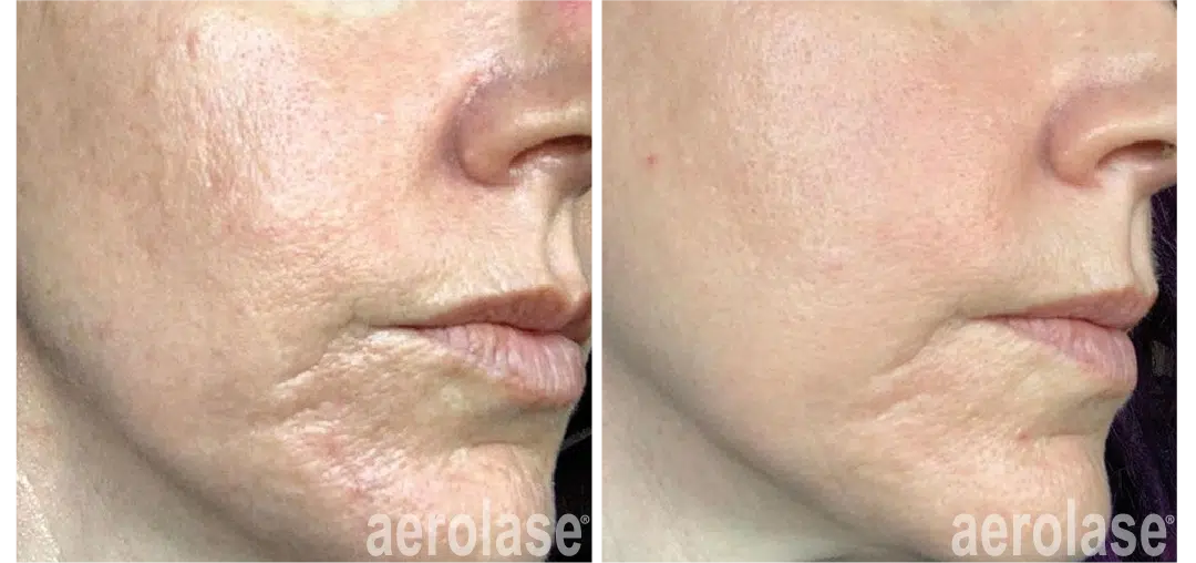 Side view of a woman's cheek and chin before and after Aerolase laser treatment, with smoother skin texture